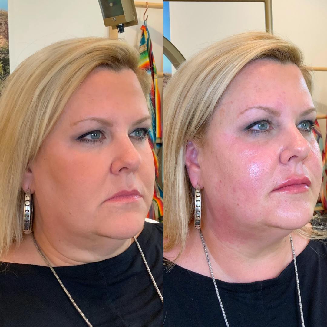 Facial Rejuvenation  Before & After Gallery - Patient 383350 - Image 2