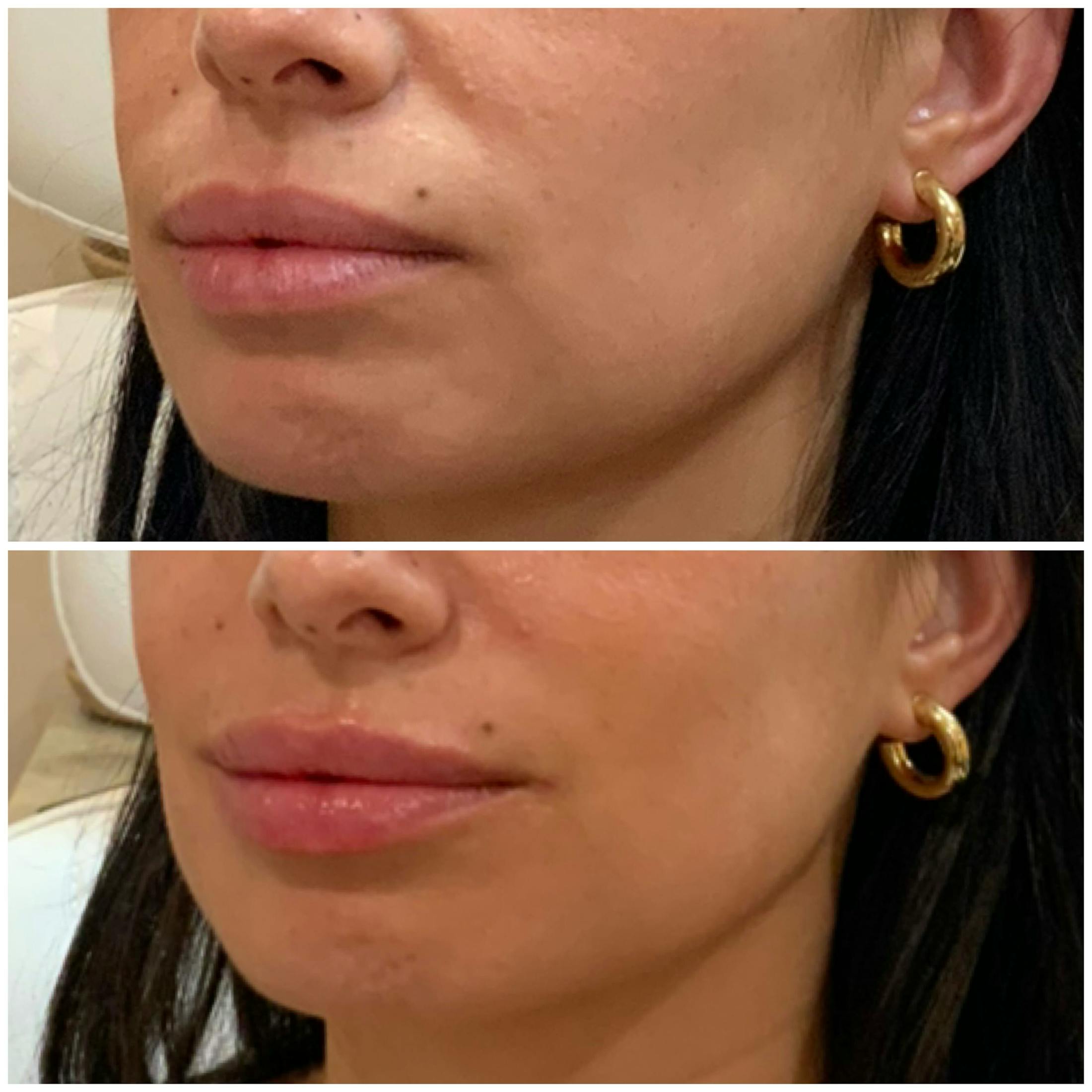 Lips Before & After Gallery - Patient 155909 - Image 2
