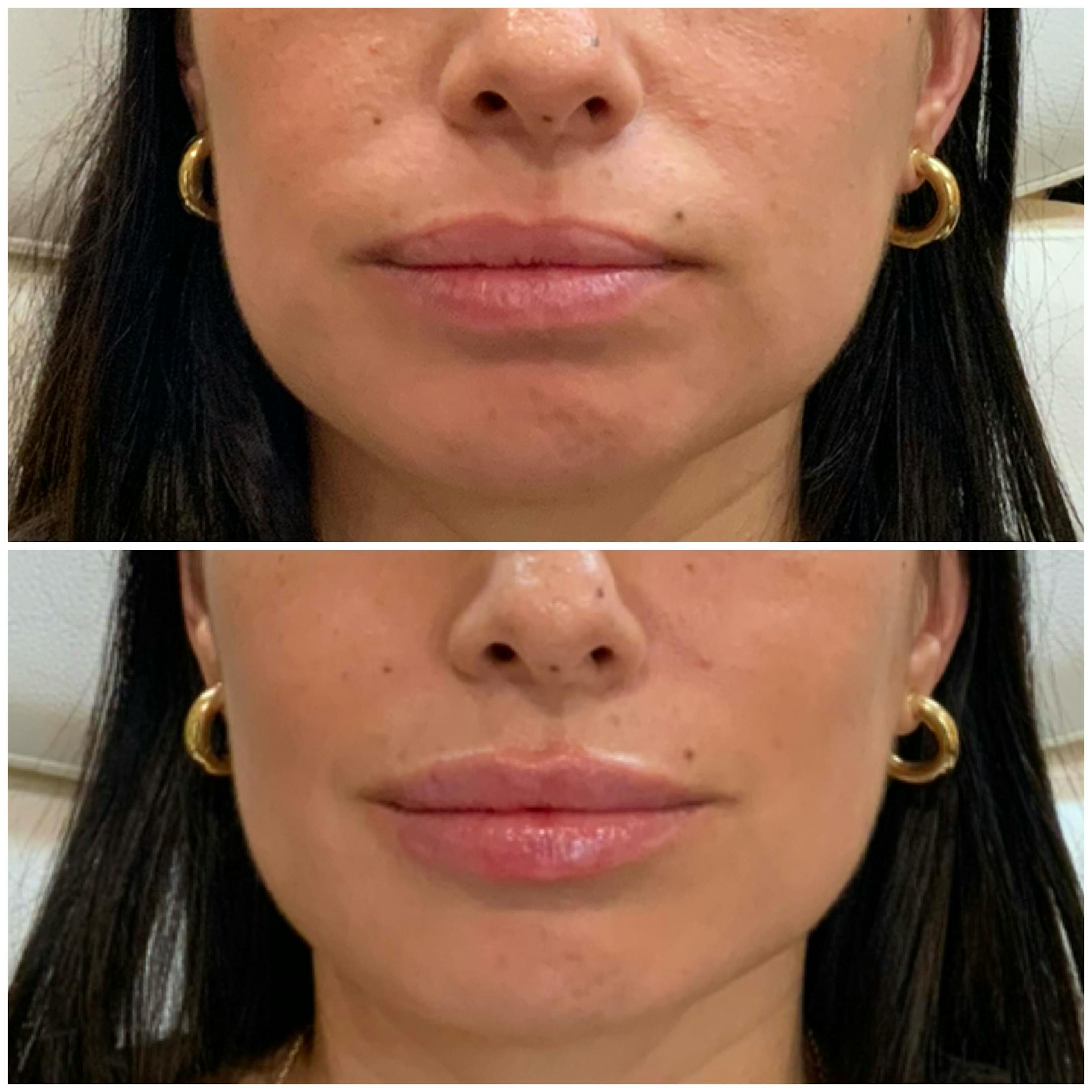 Lips Before & After Gallery - Patient 155909 - Image 1