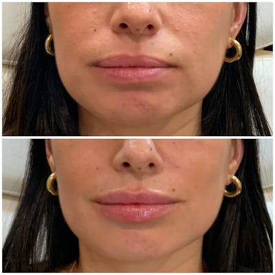 Lips Before & After Gallery - Patient 155909 - Image 1