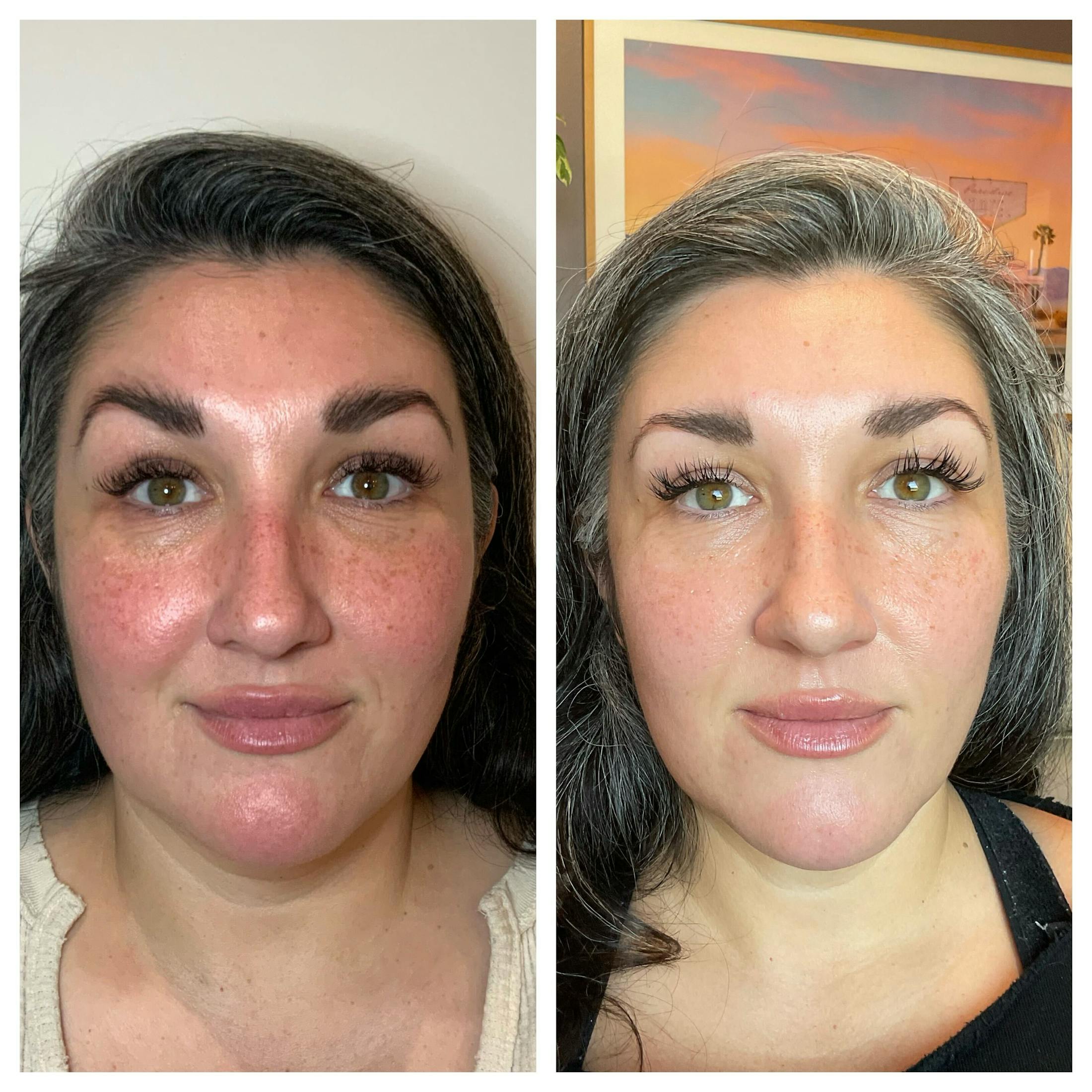 Tear Troughs Before & After Gallery - Patient 531109 - Image 1