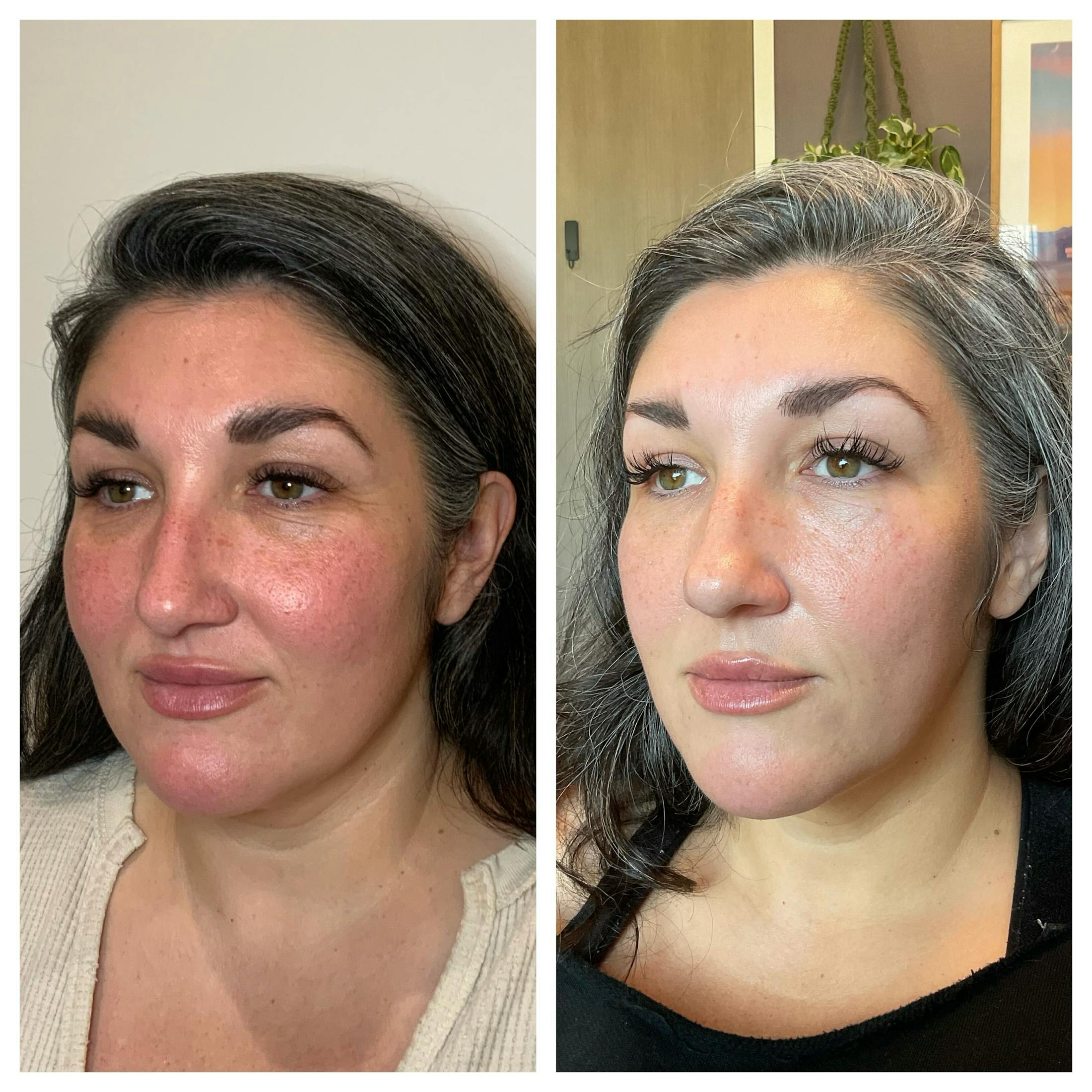 Tear Troughs Before & After Gallery - Patient 531109 - Image 2