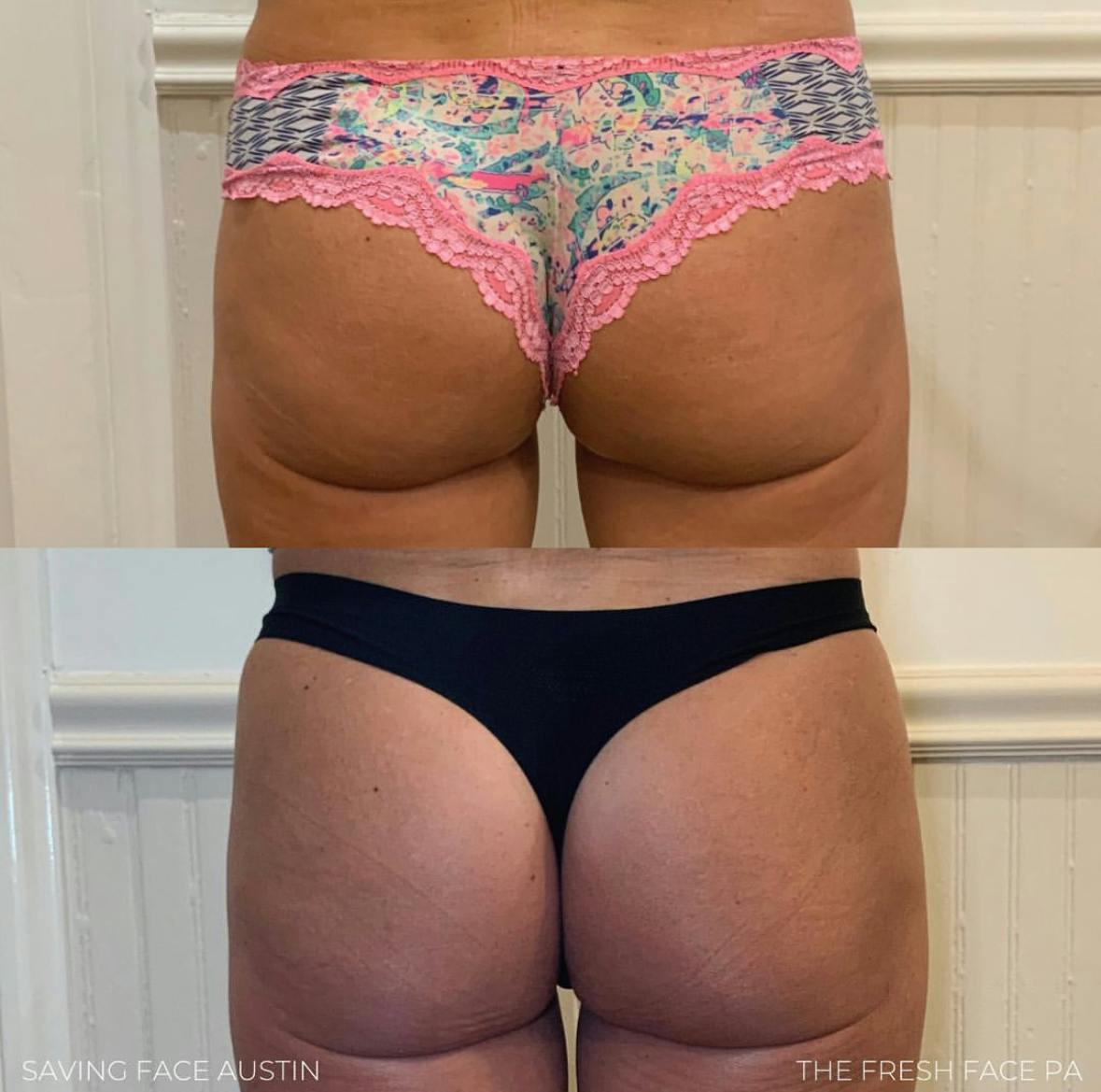 Non-Surgical BBL Before & After Gallery - Patient 177031 - Image 1
