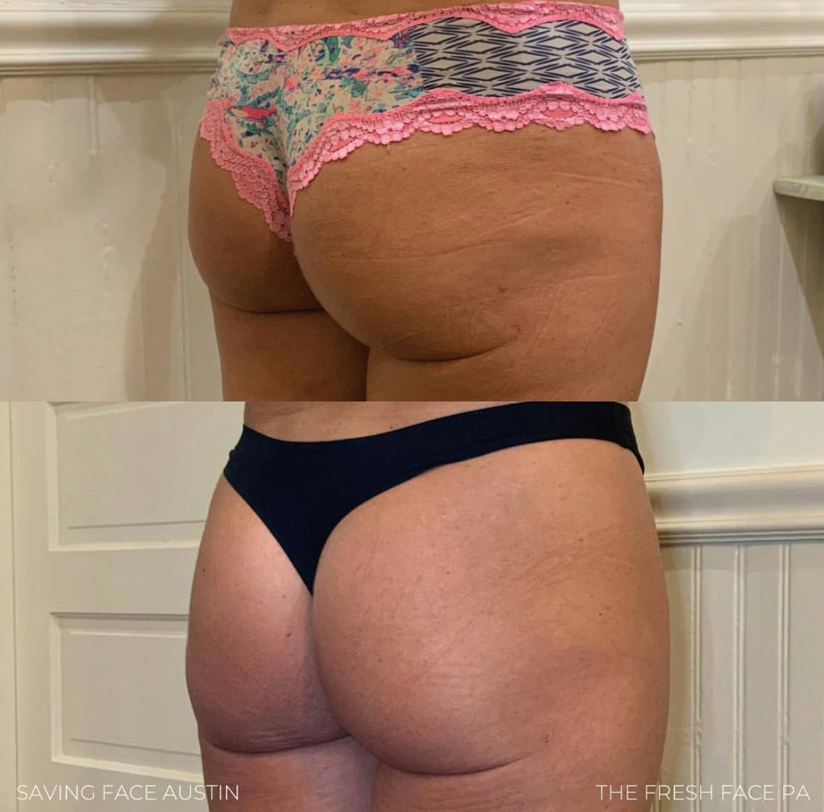 Non-Surgical BBL Before & After Gallery - Patient 177031 - Image 2