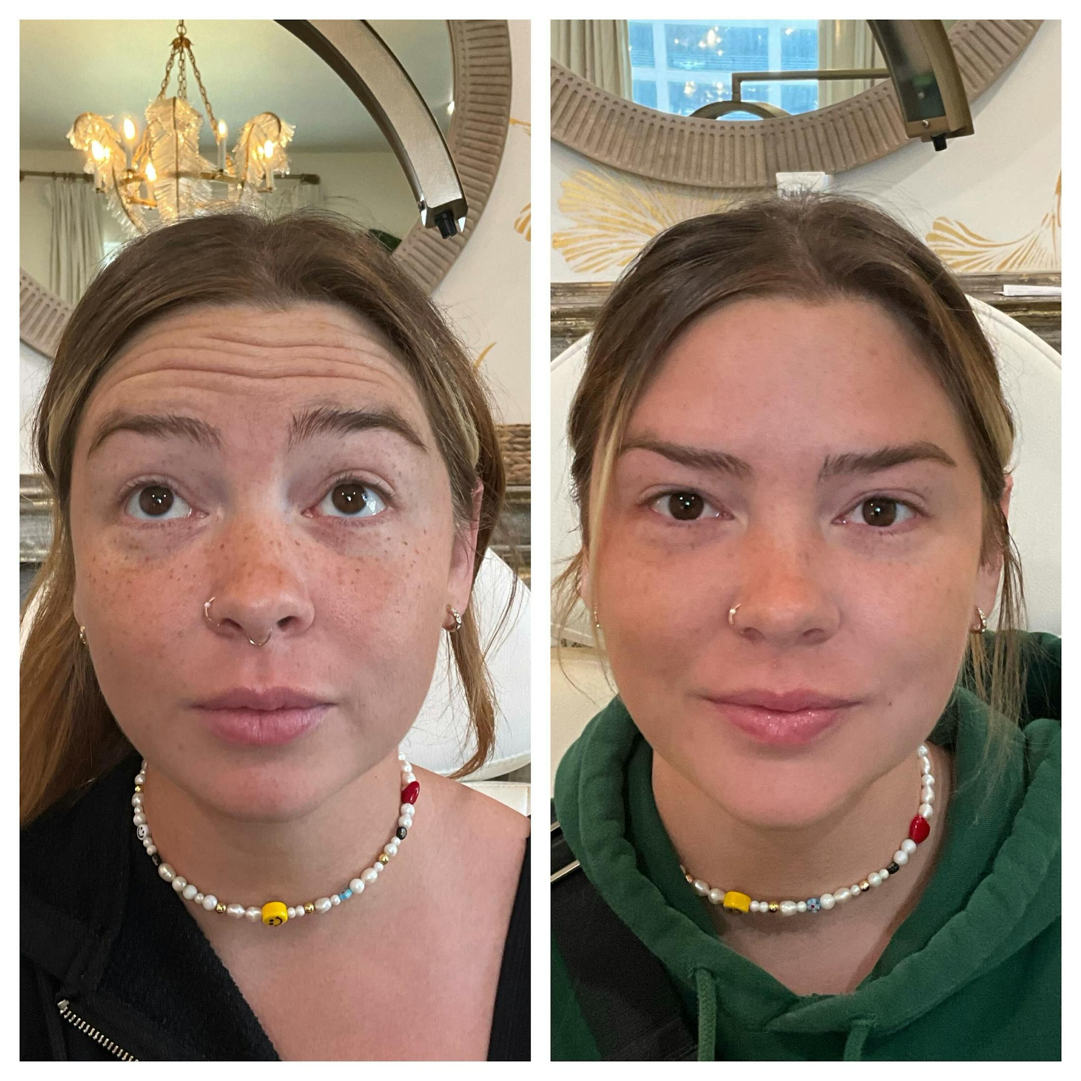 Neuromodulators Before & After Gallery - Patient 242904 - Image 1