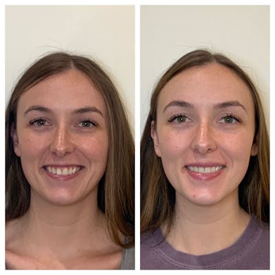 Lips Before & After Gallery - Patient 295202 - Image 1