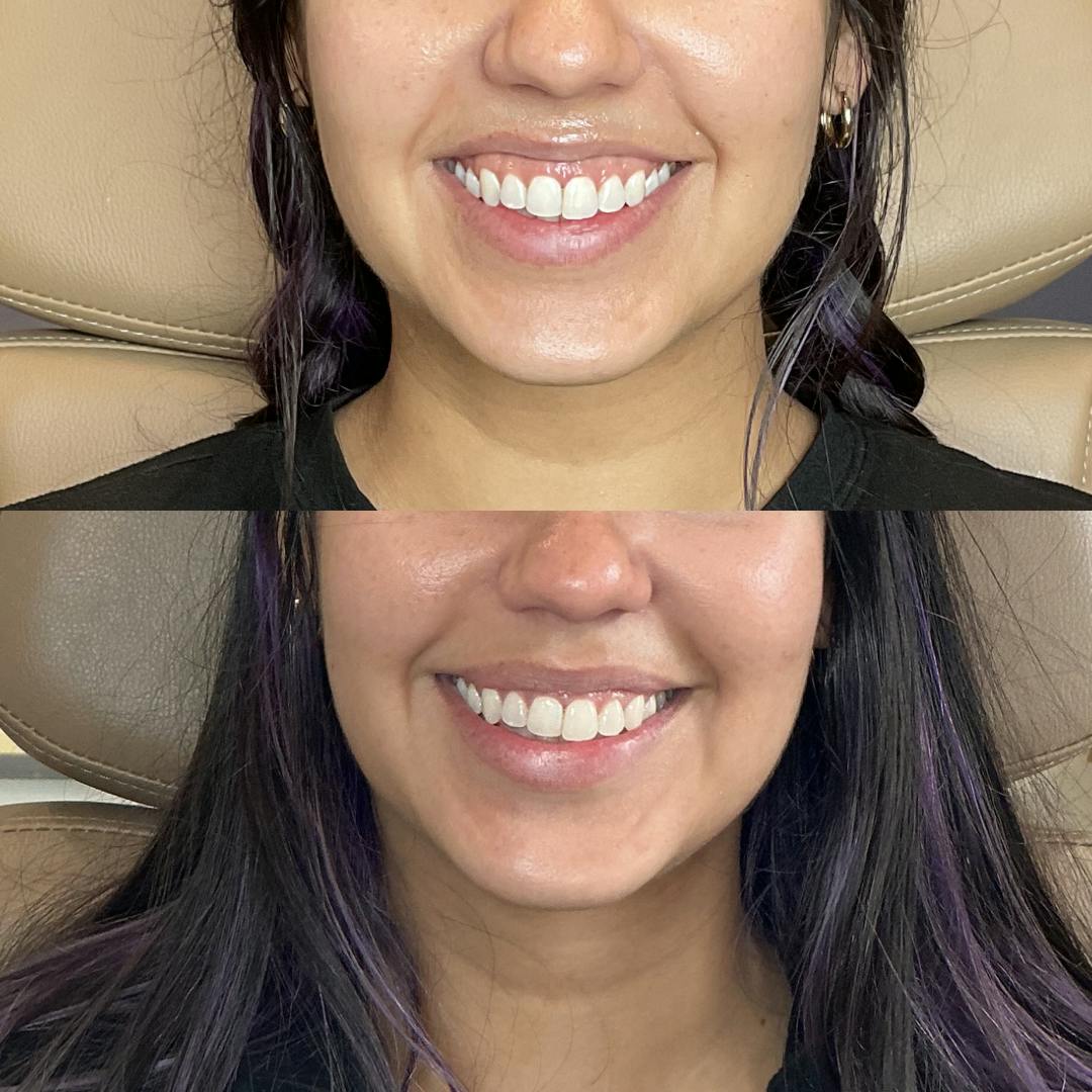 Platysmal Bands Before & After Gallery - Patient 379145 - Image 1