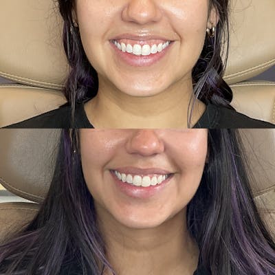 Platysmal Bands Before & After Gallery - Patient 379145 - Image 1