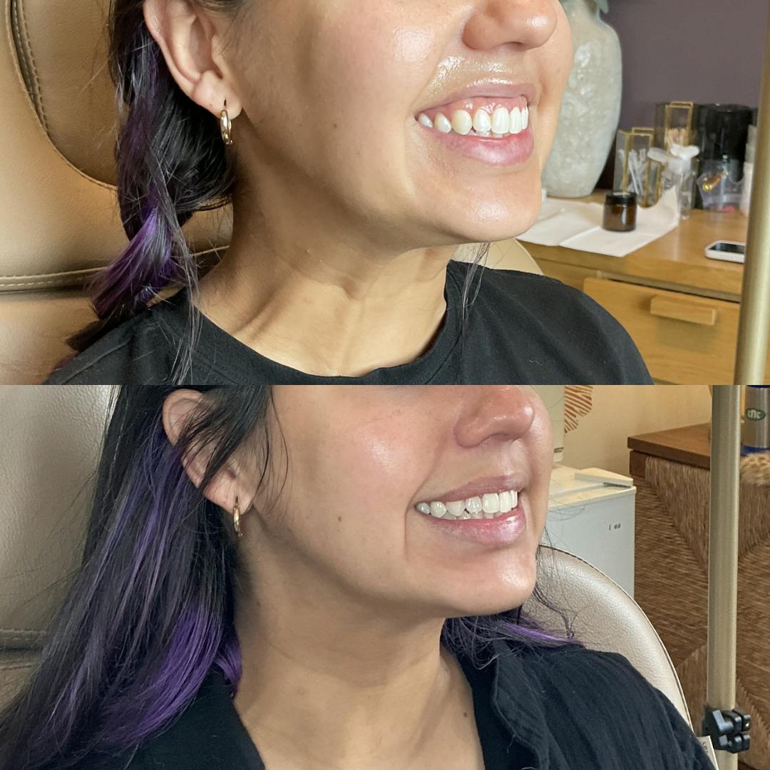 Platysmal Bands Before & After Gallery - Patient 379145 - Image 2