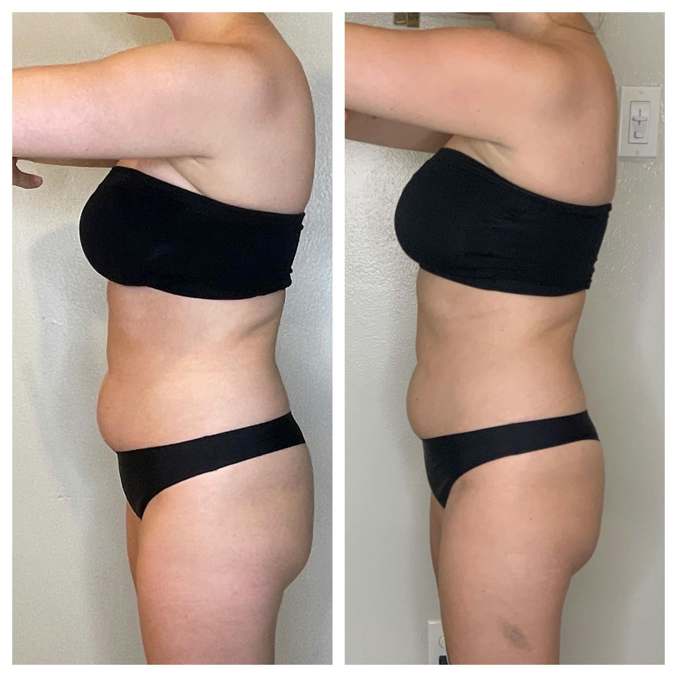 EON Before & After Gallery - Patient 439490 - Image 1