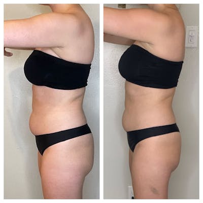 EON Before & After Gallery - Patient 439490 - Image 1