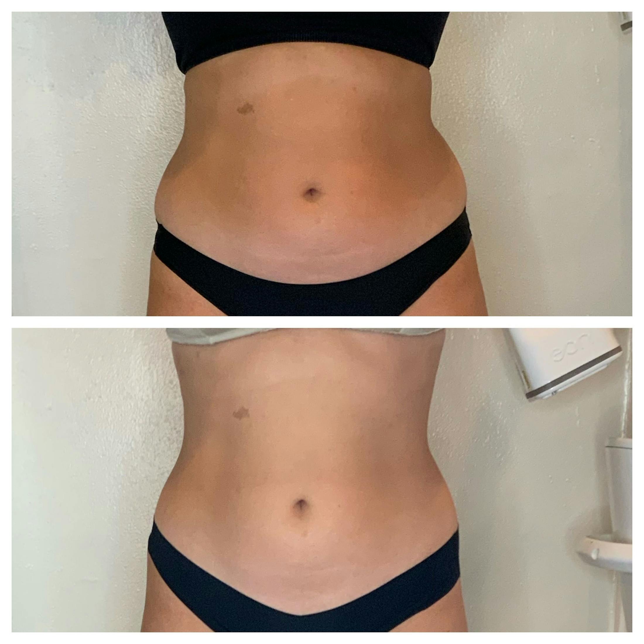 EON Before & After Gallery - Patient 454400 - Image 1