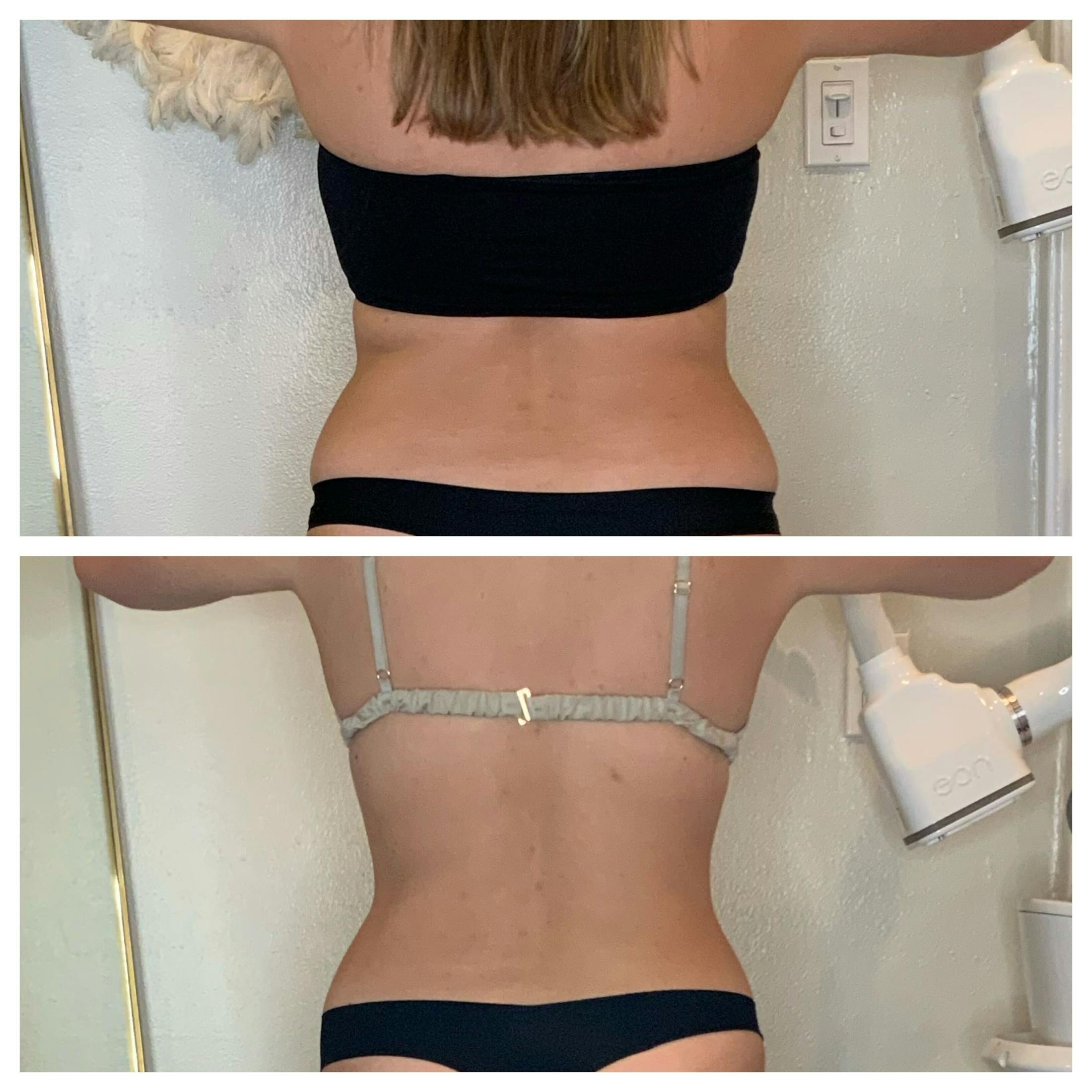 EON Before & After Gallery - Patient 454400 - Image 2