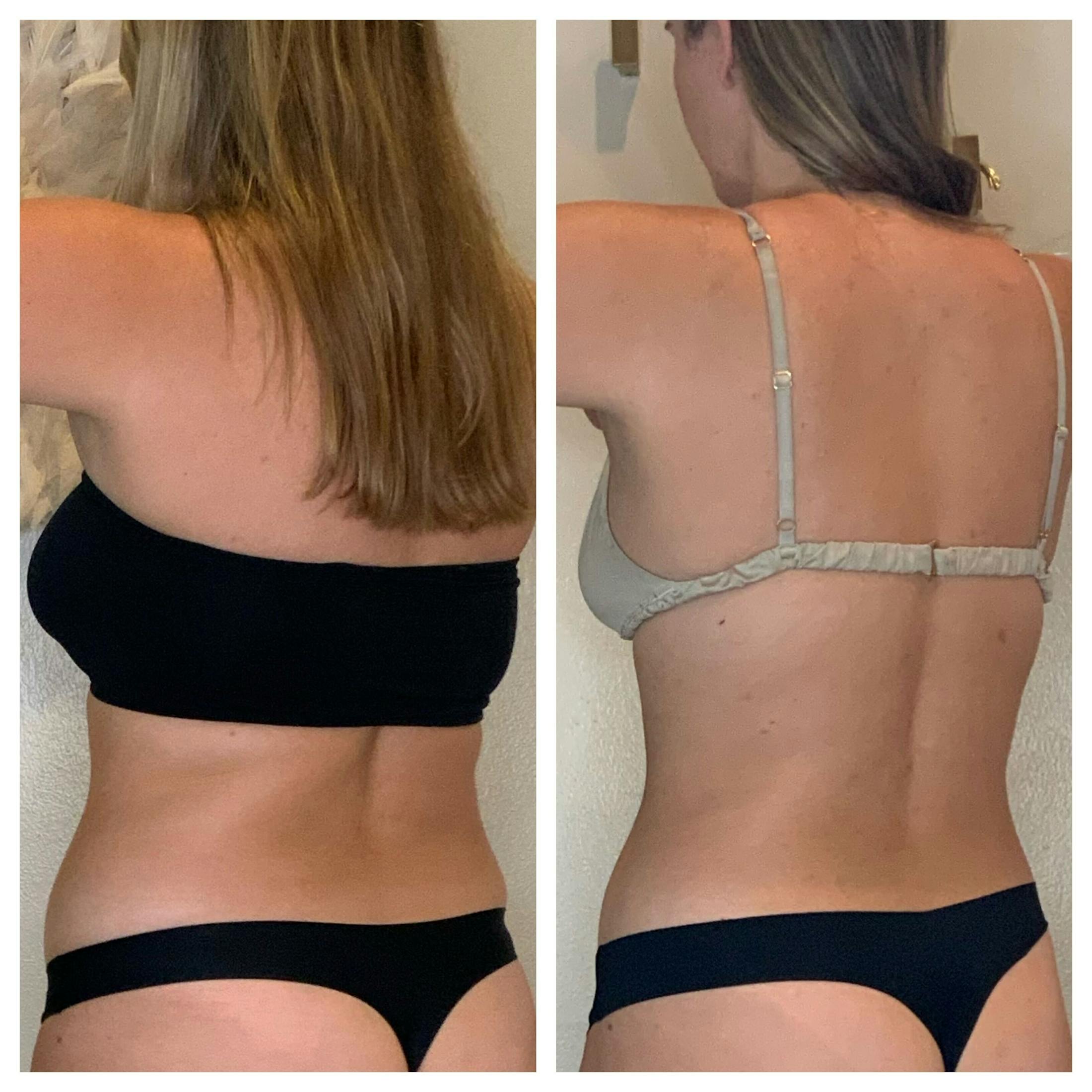 EON Before & After Gallery - Patient 454400 - Image 3