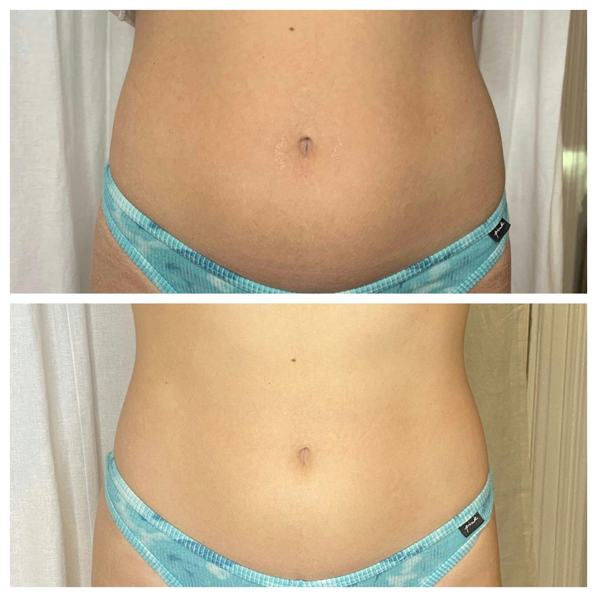 EON Before & After Gallery - Patient 301428 - Image 1