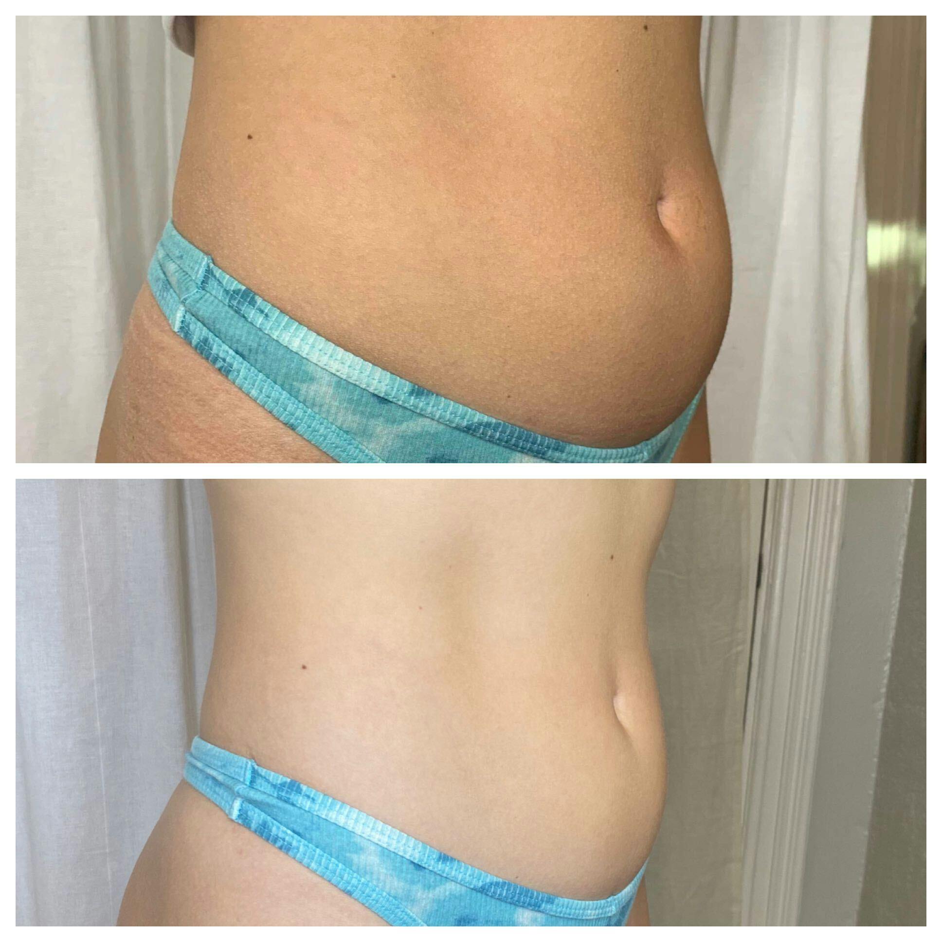 EON Before & After Gallery - Patient 301428 - Image 2