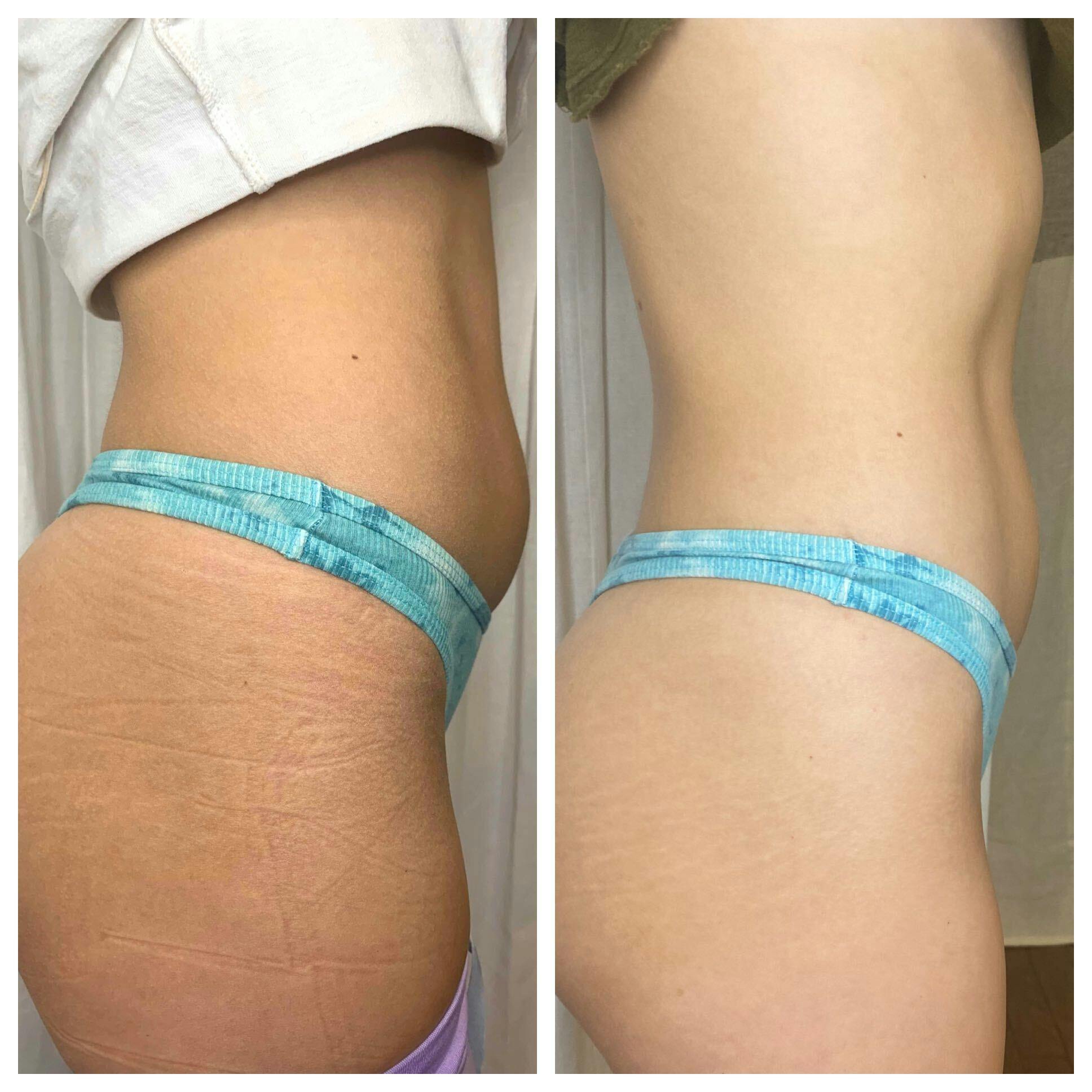 EON Before & After Gallery - Patient 301428 - Image 3