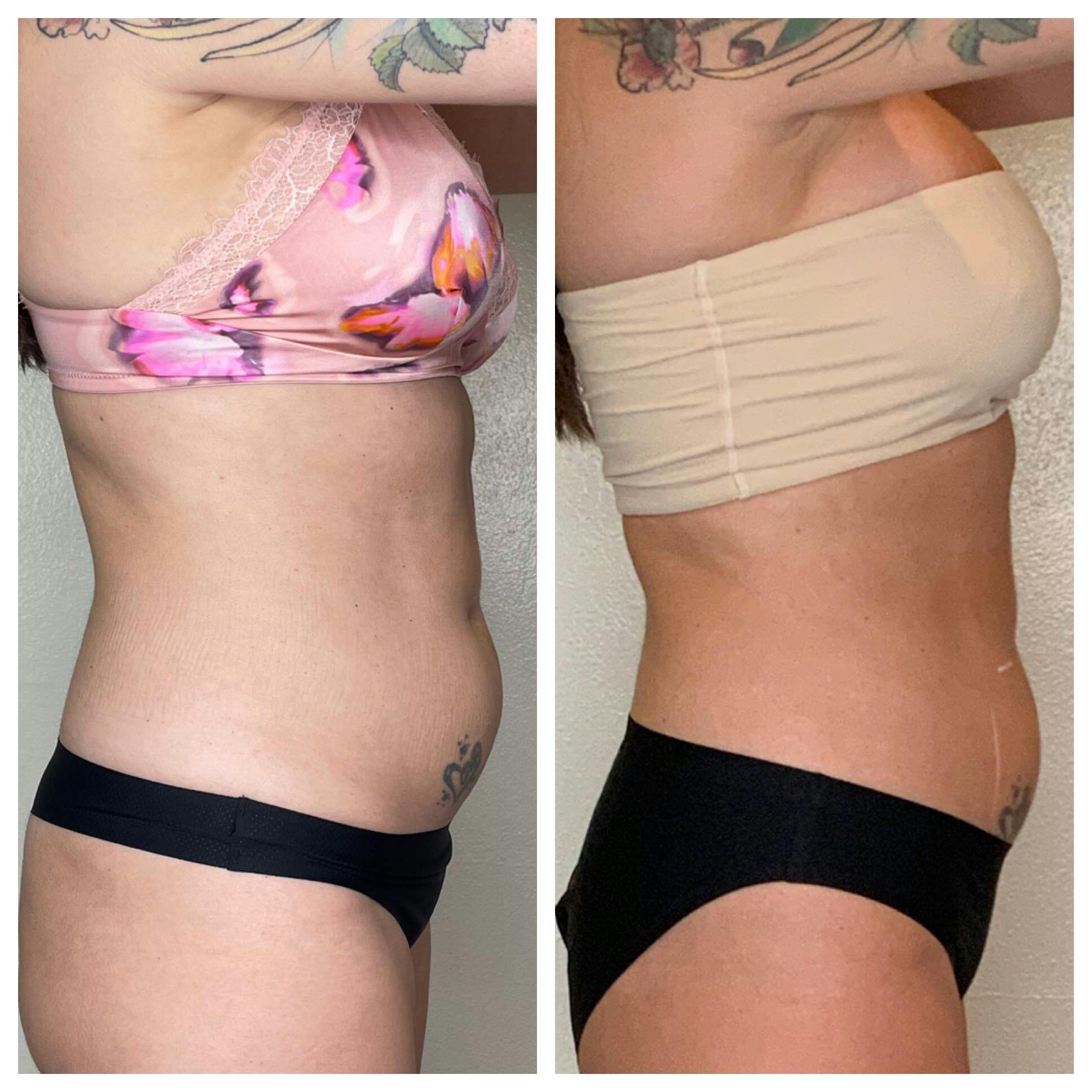 EON Before & After Gallery - Patient 315803 - Image 1