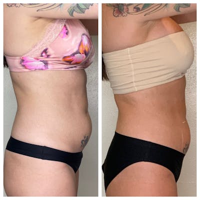 EON Before & After Gallery - Patient 315803 - Image 1