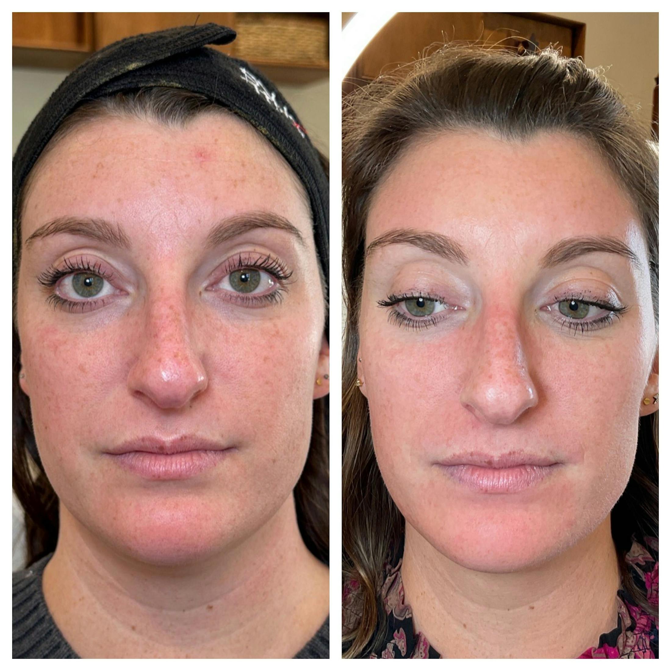 IPL Before & After Gallery - Patient 195598 - Image 1