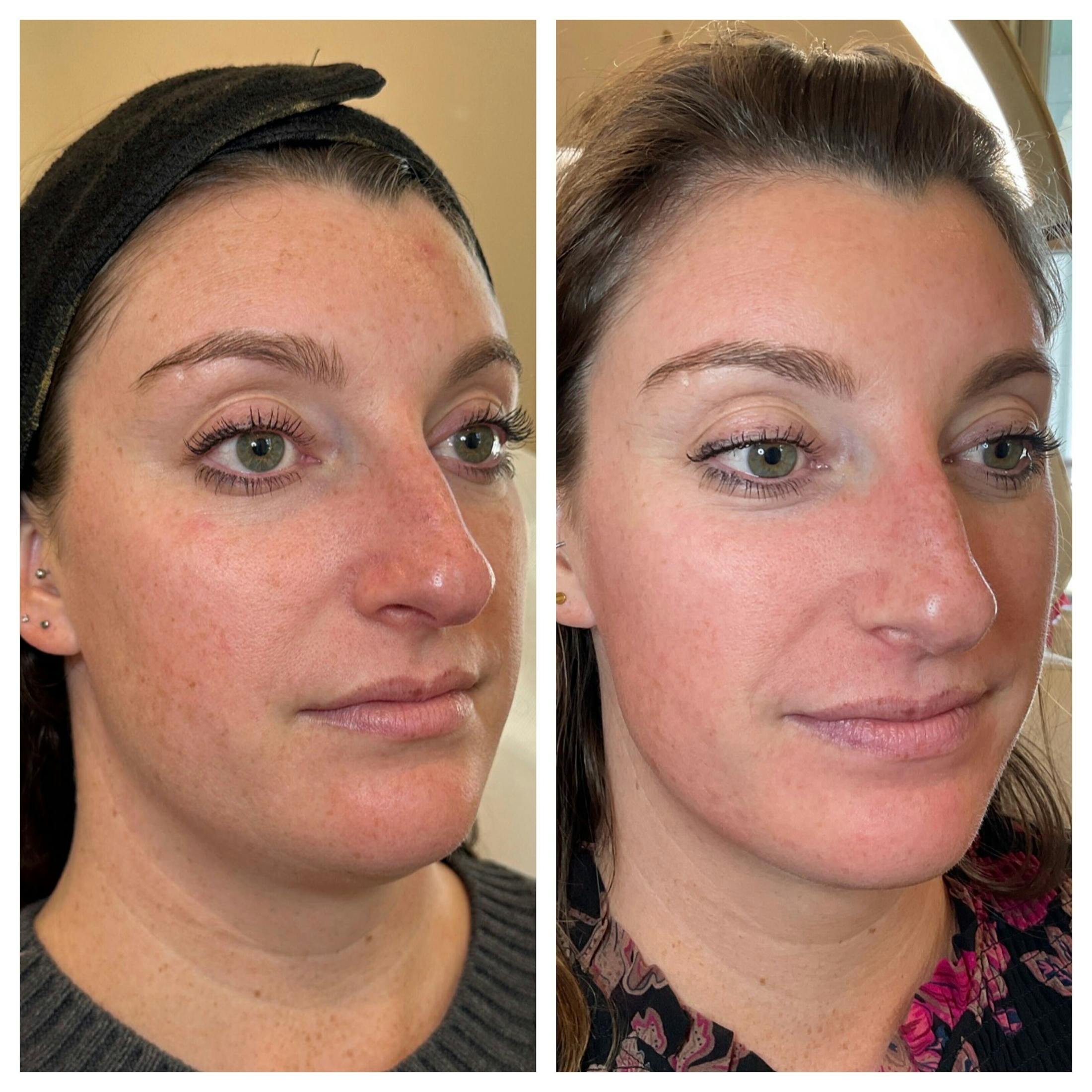 IPL Before & After Gallery - Patient 195598 - Image 2