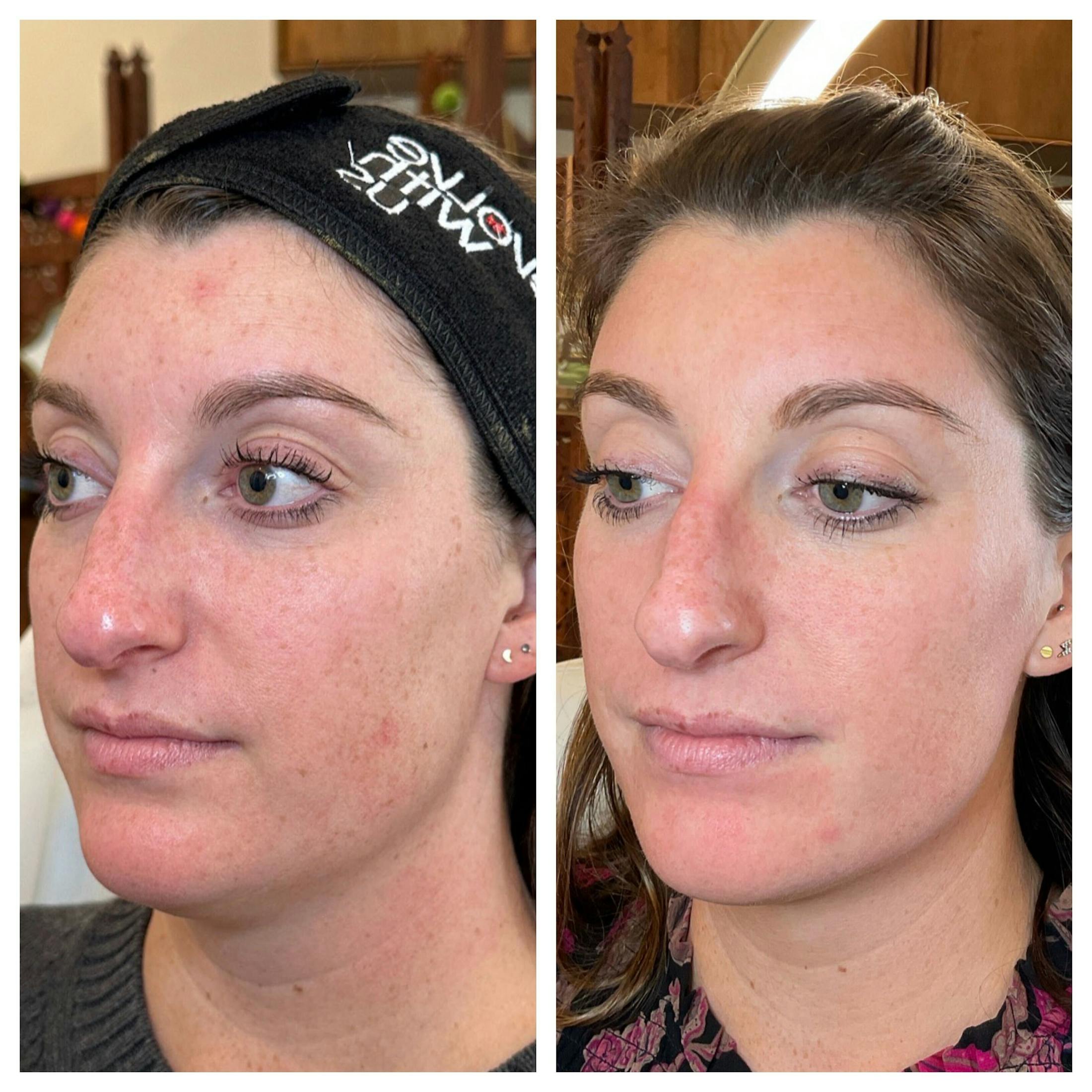 IPL Before & After Gallery - Patient 195598 - Image 3
