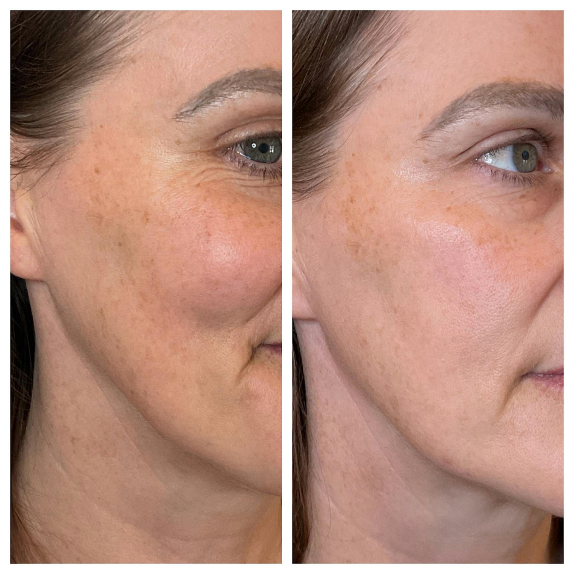 IPL Before & After Gallery - Patient 940643 - Image 1