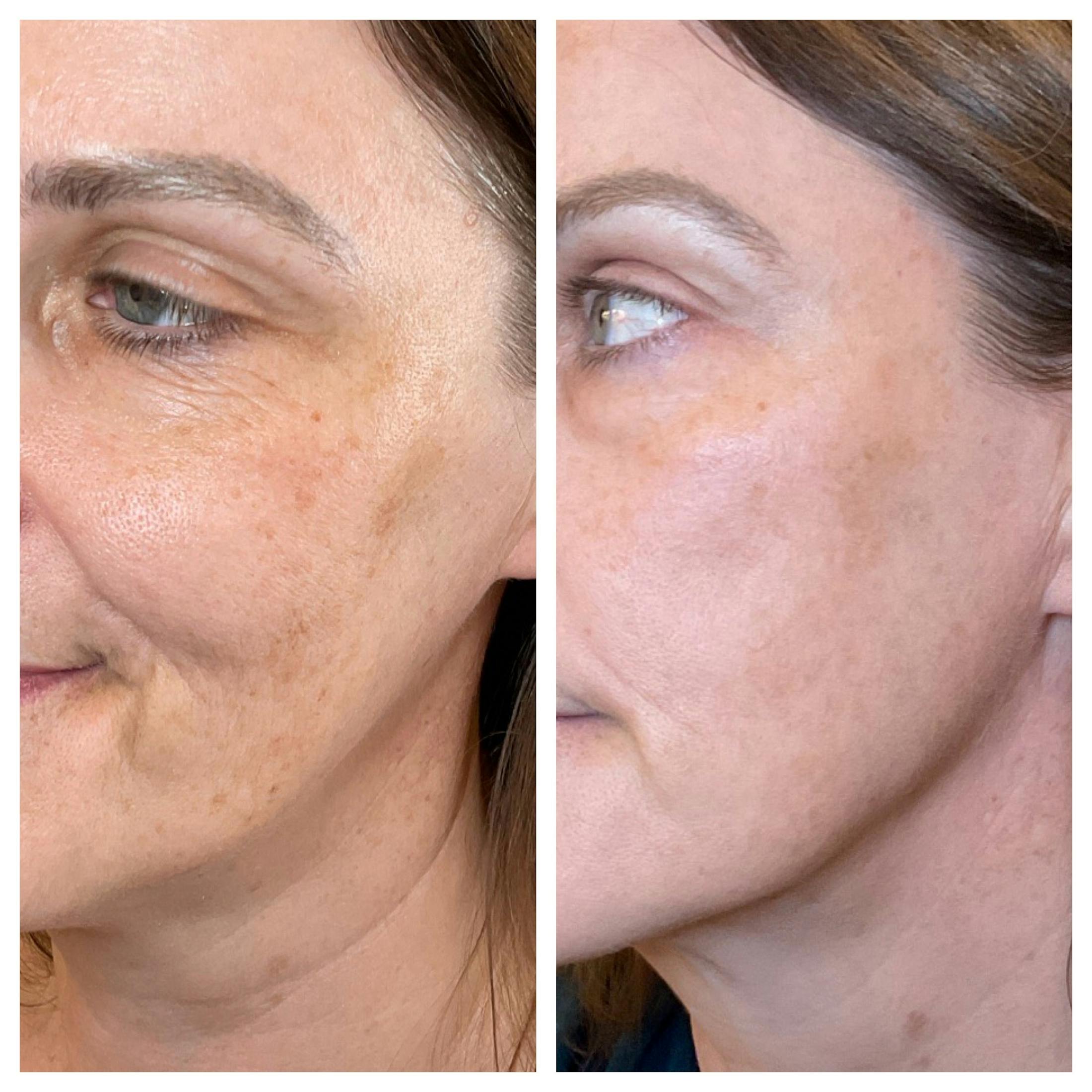 IPL Before & After Gallery - Patient 940643 - Image 2