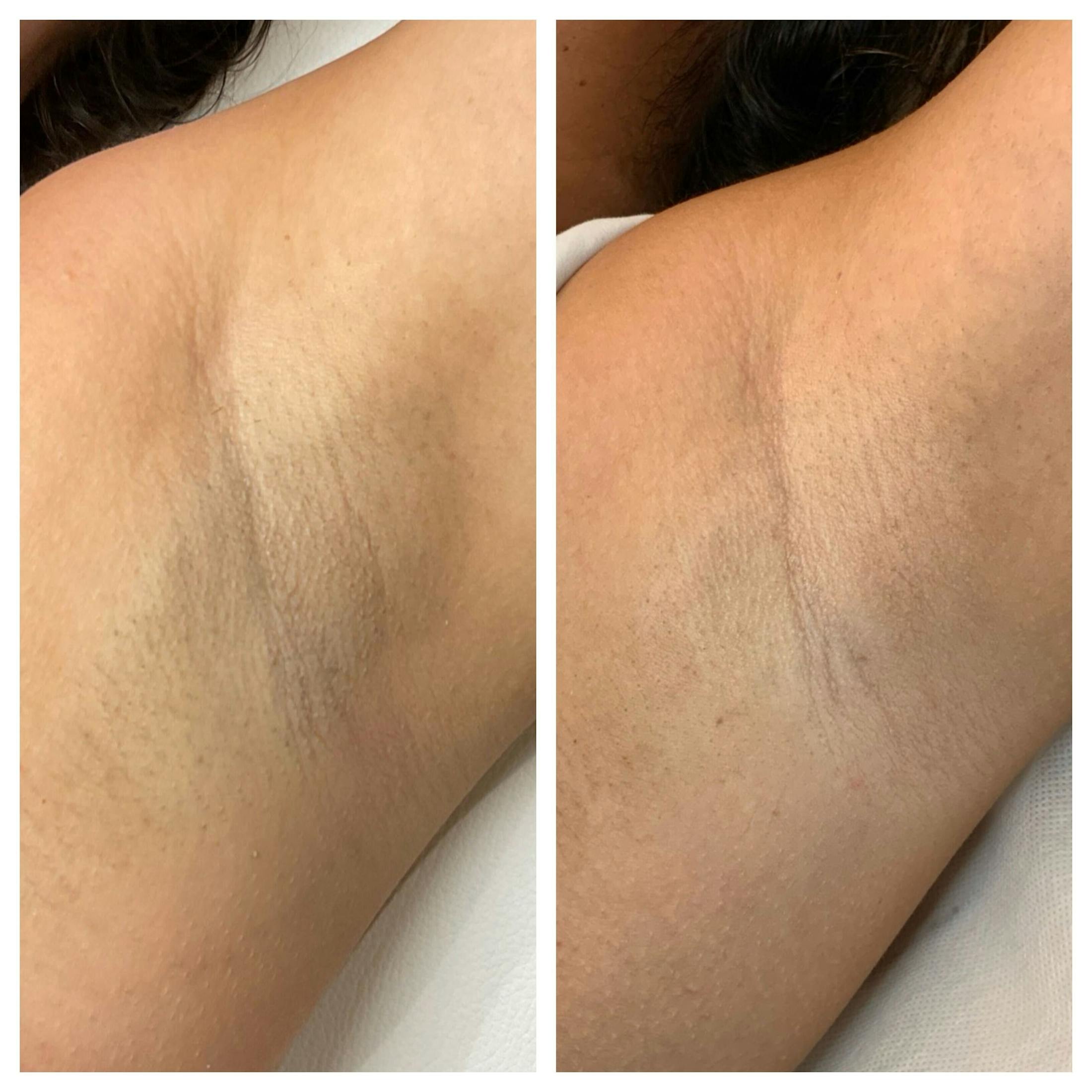 Laser Hair Removal Before & After Gallery - Patient 410455 - Image 2