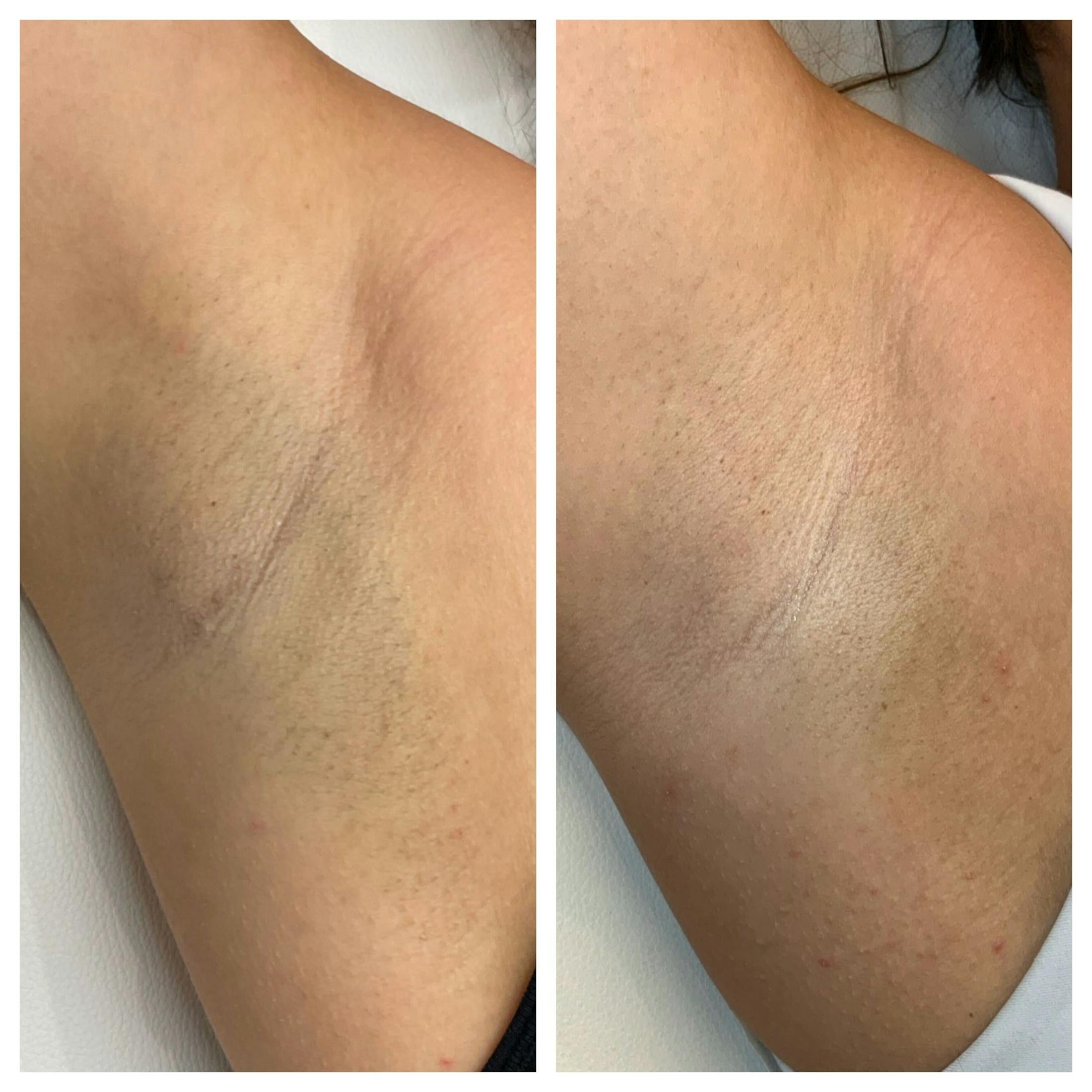 Laser Hair Removal Before & After Gallery - Patient 410455 - Image 1