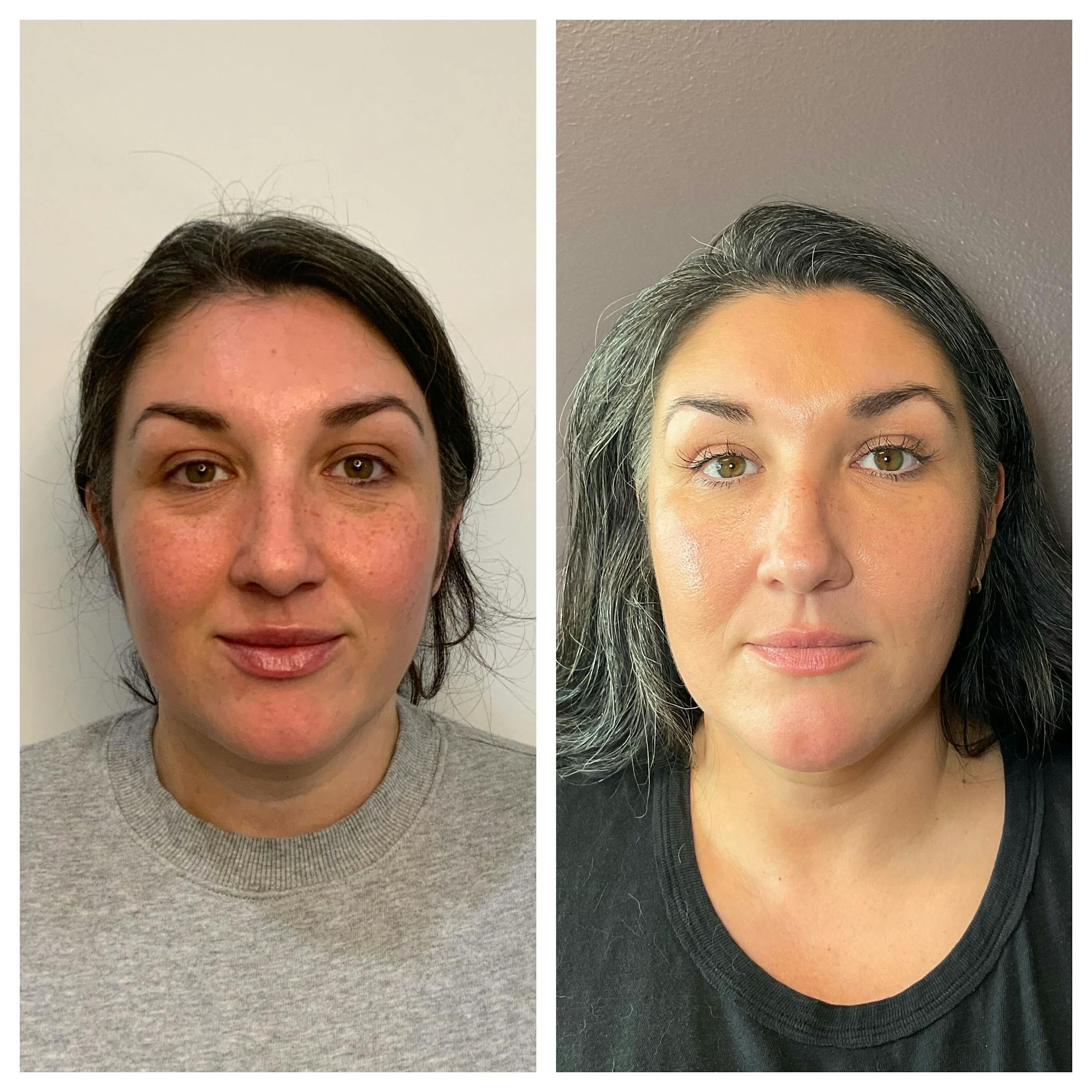 Saving Face Filter Before & After Gallery - Patient 179772 - Image 1