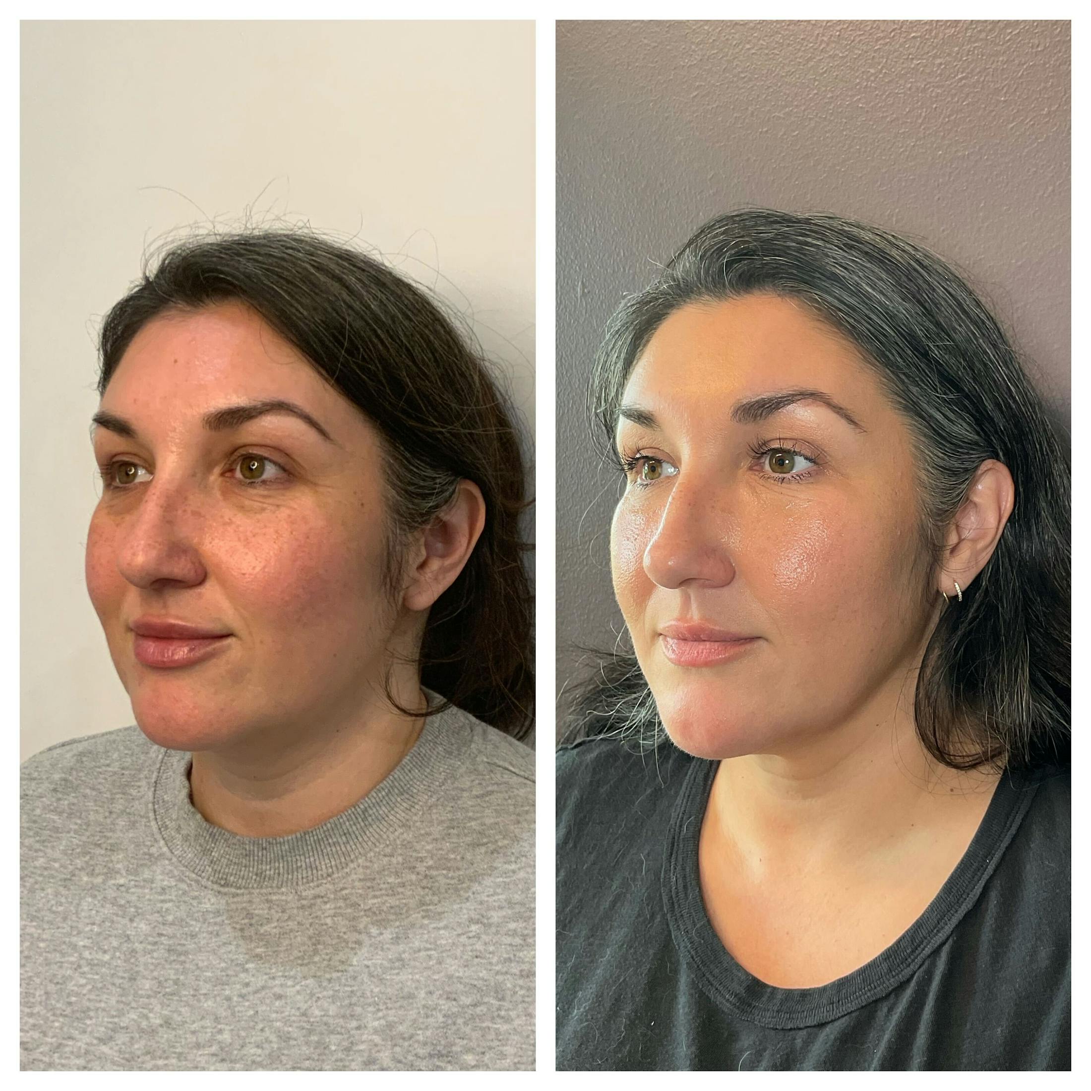 Saving Face Filter Before & After Gallery - Patient 179772 - Image 3