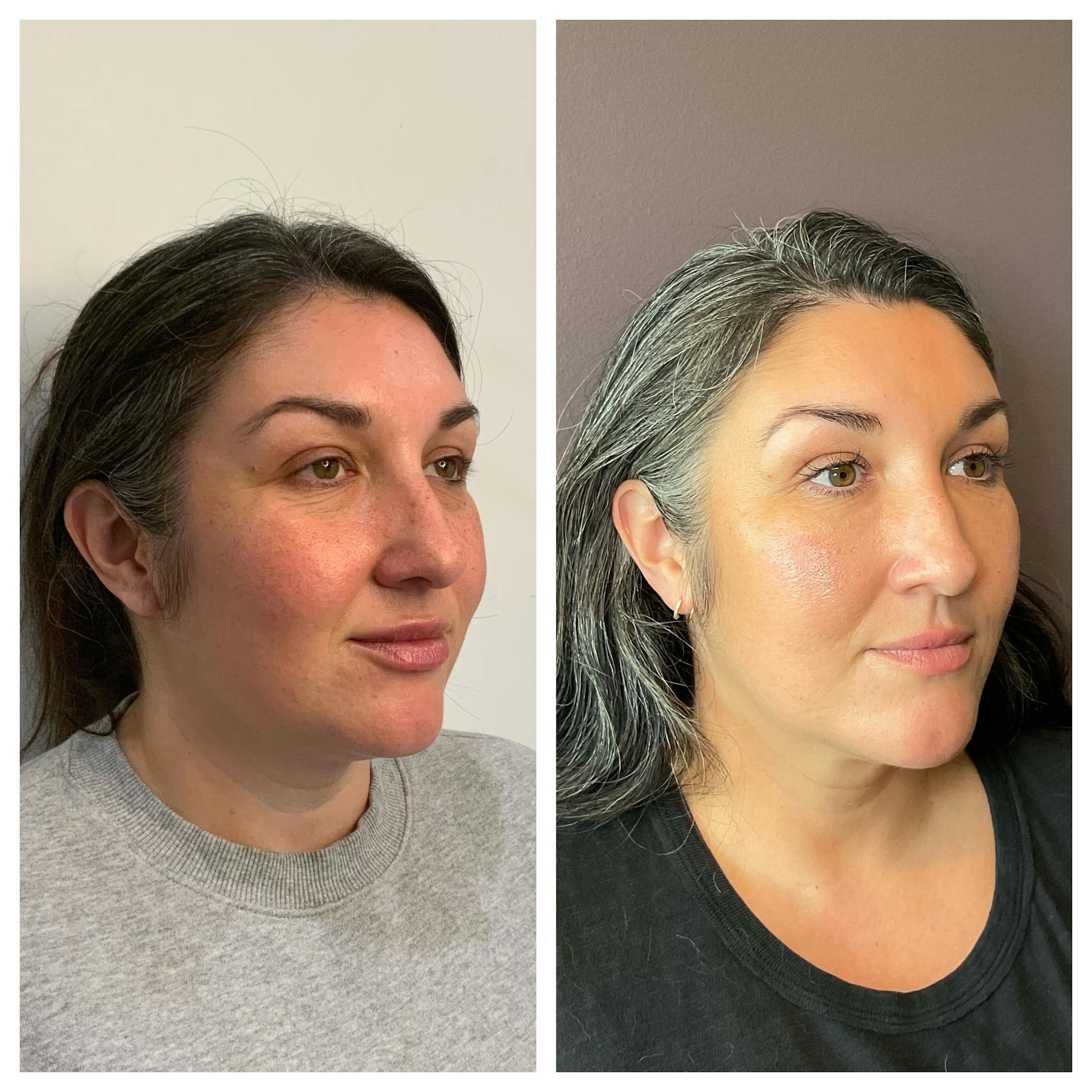 Saving Face Filter Before & After Gallery - Patient 179772 - Image 2