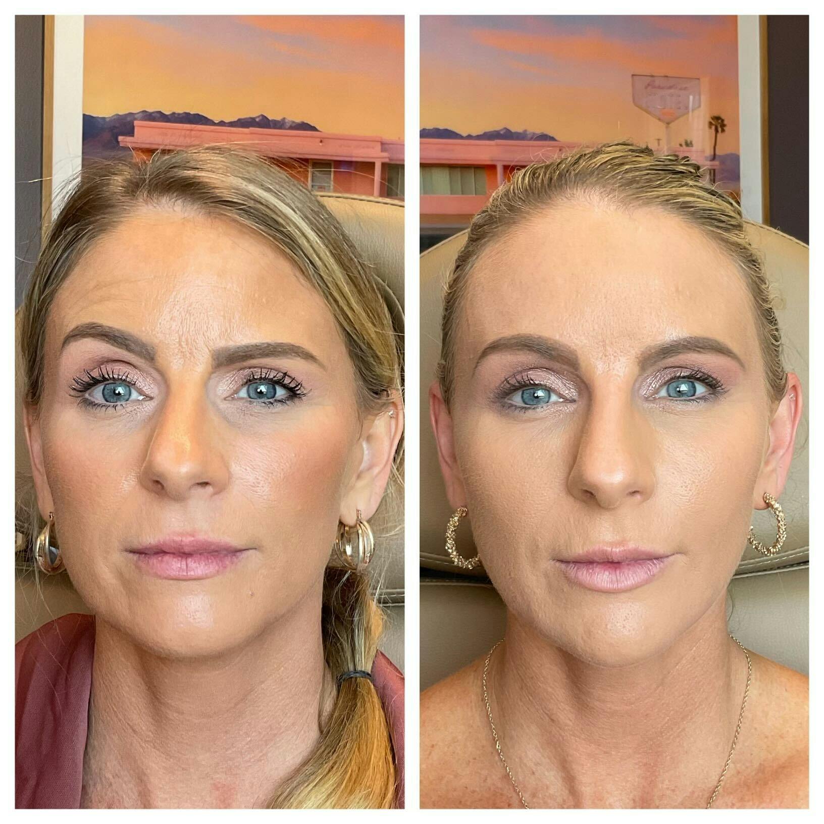 Saving Face Filter Before & After Gallery - Patient 411836 - Image 1