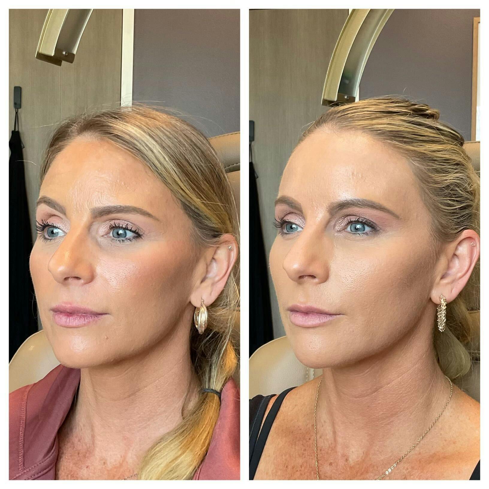 Saving Face Filter Before & After Gallery - Patient 411836 - Image 3
