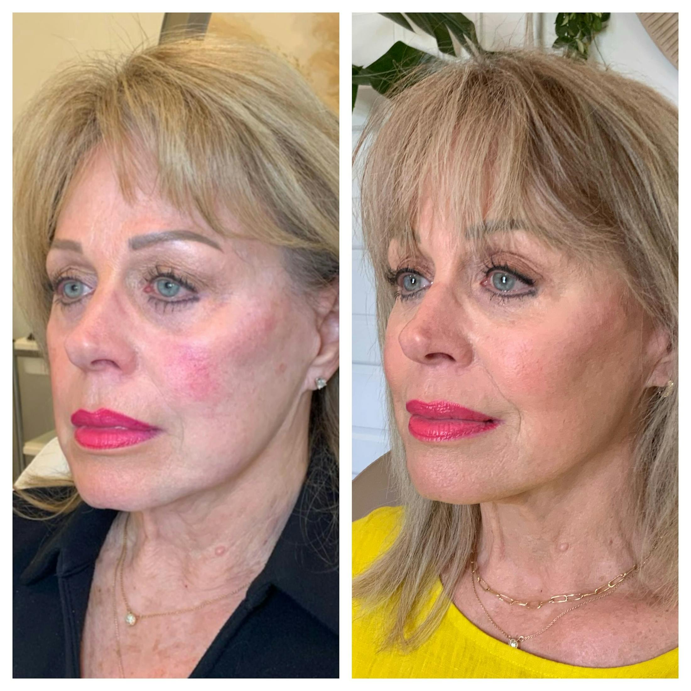Saving Face Filter Before & After Gallery - Patient 318029 - Image 3