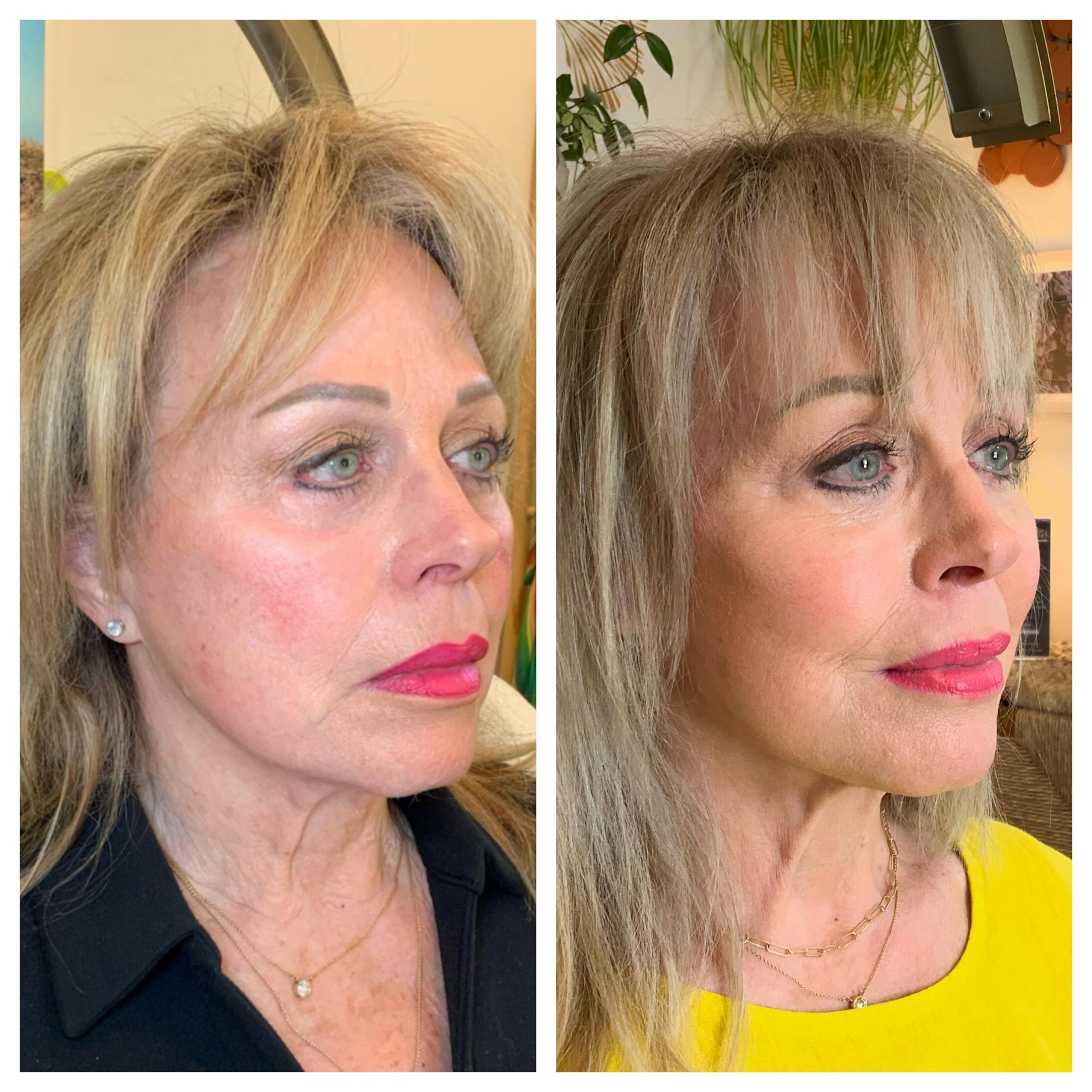 Saving Face Filter Before & After Gallery - Patient 318029 - Image 2