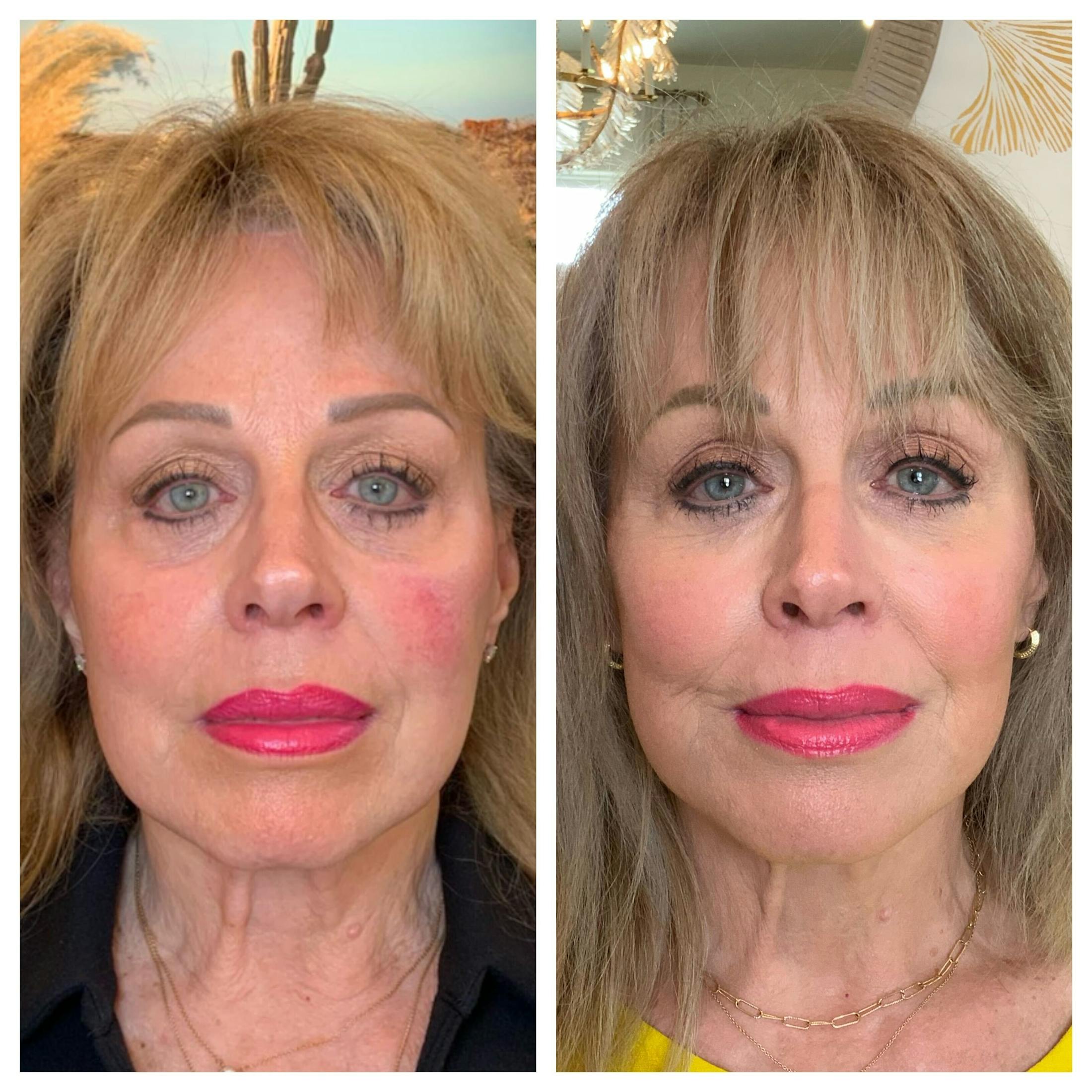 Saving Face Filter Before & After Gallery - Patient 318029 - Image 1