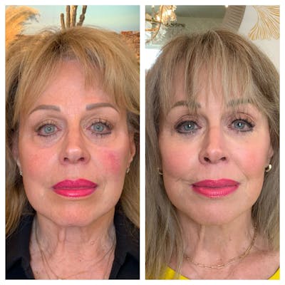 Saving Face Filter Before & After Gallery - Patient 318029 - Image 1
