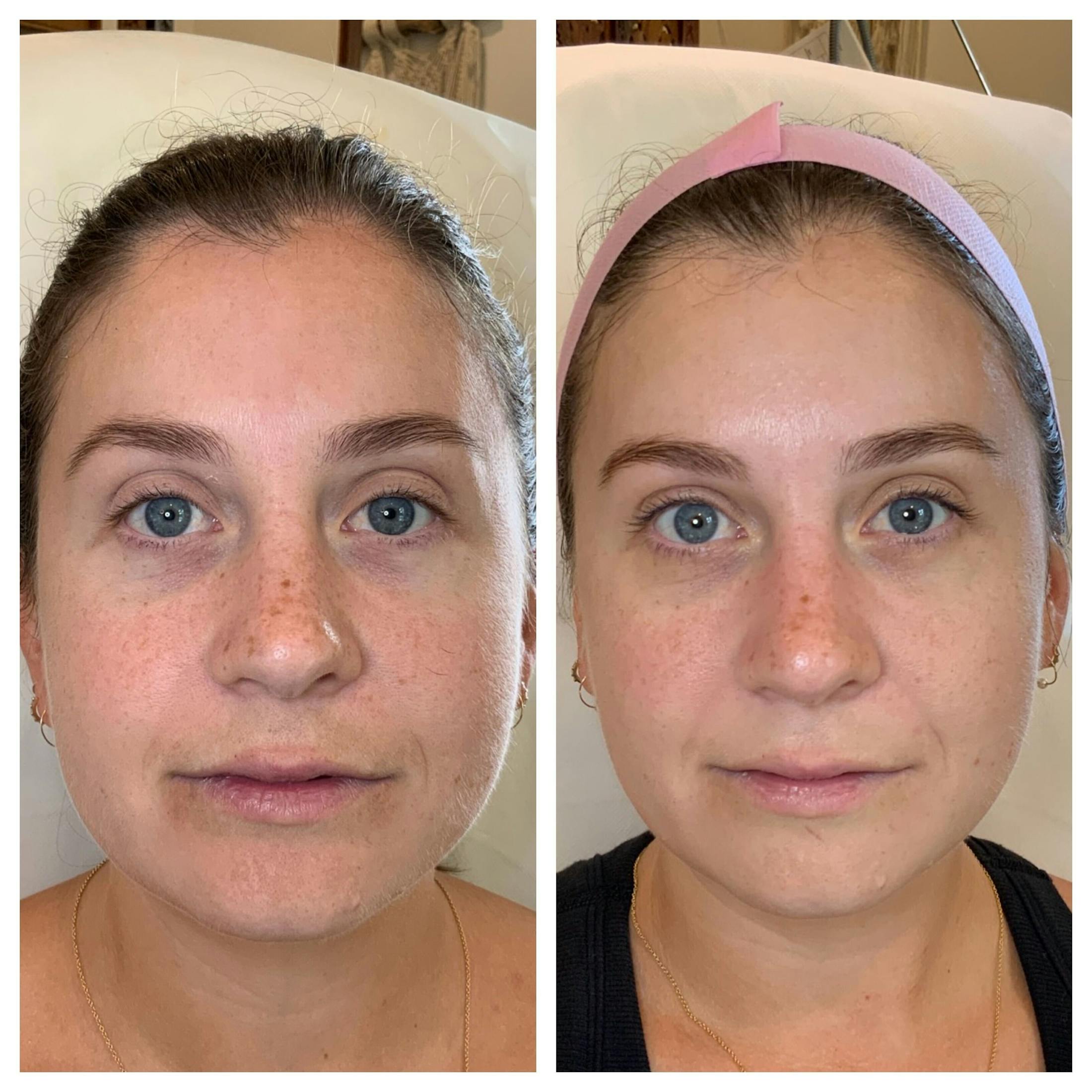 SkinPen Before & After Gallery - Patient 289532 - Image 1