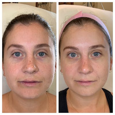 SkinPen Before & After Gallery - Patient 289532 - Image 1
