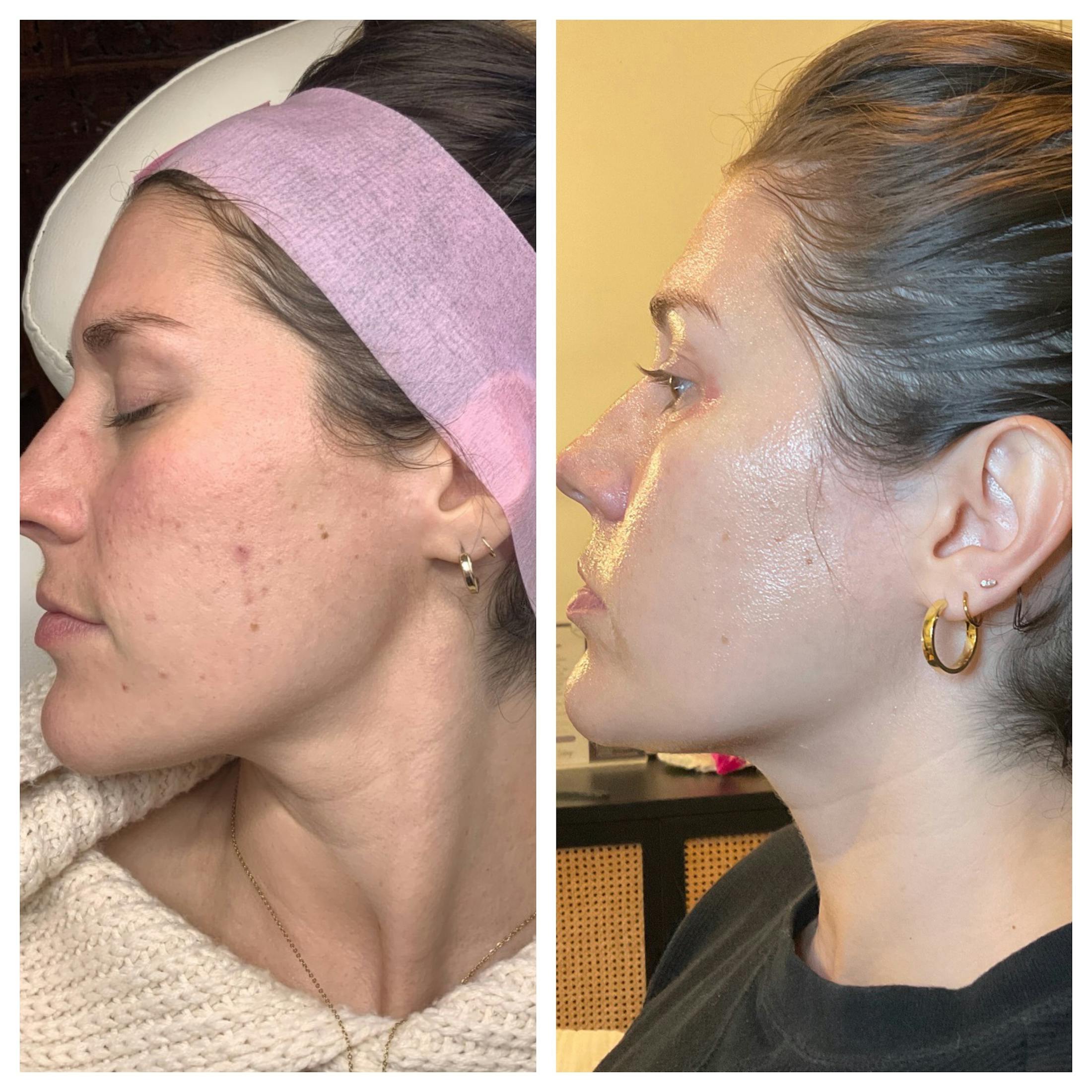 SkinPen Before & After Gallery - Patient 289532 - Image 3