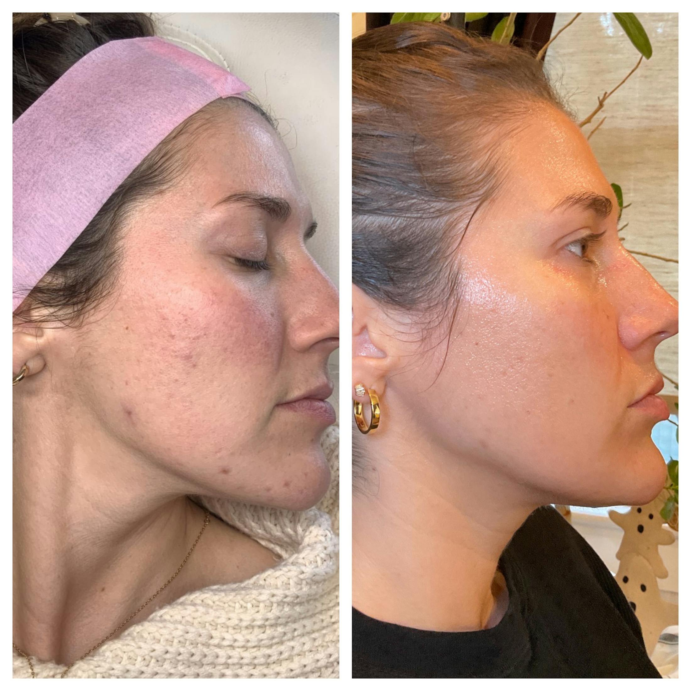 SkinPen Before & After Gallery - Patient 289532 - Image 2