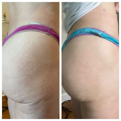 Stretch Mark Before & After Gallery - Patient 355243 - Image 1