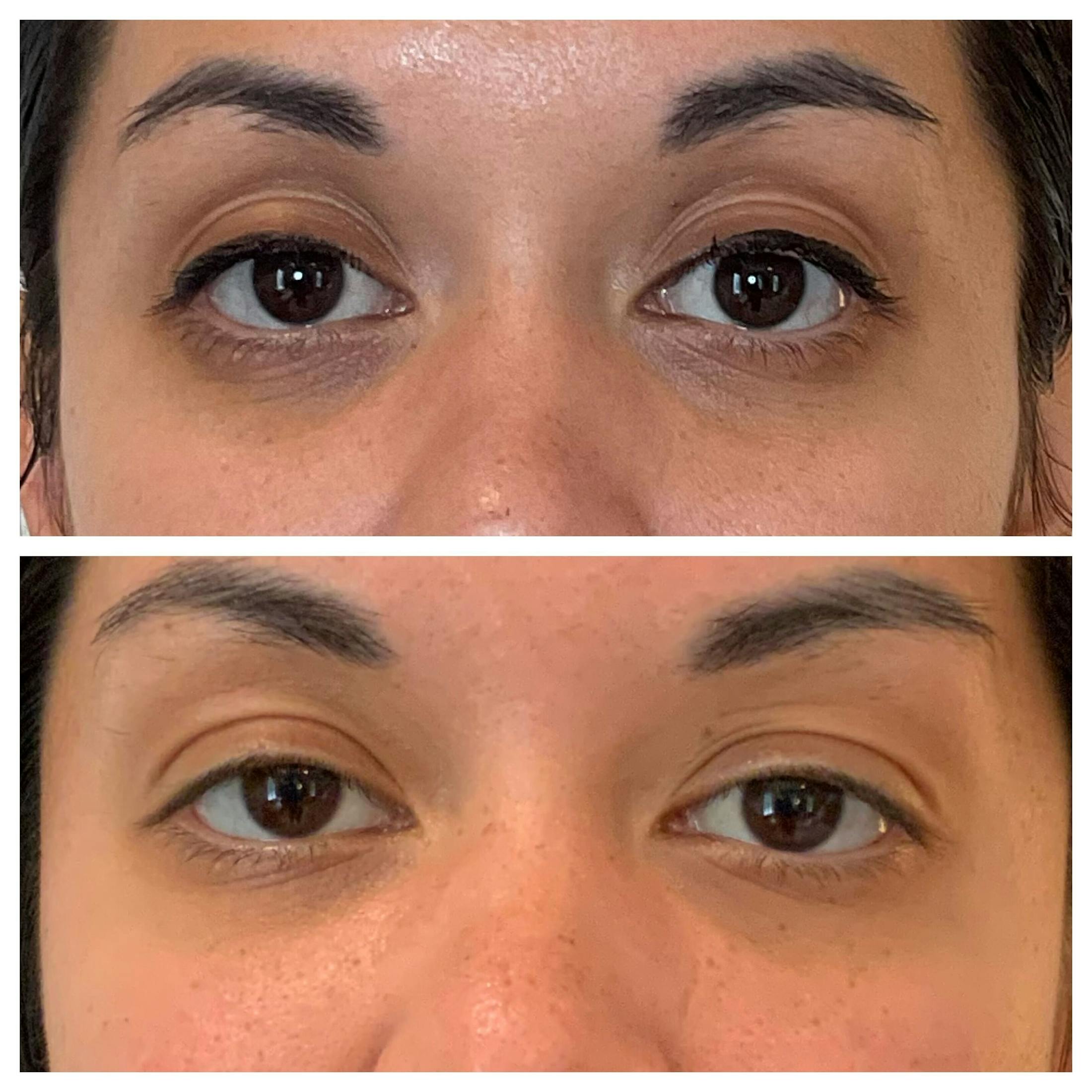 Tear Troughs Before & After Gallery - Patient 111321 - Image 1