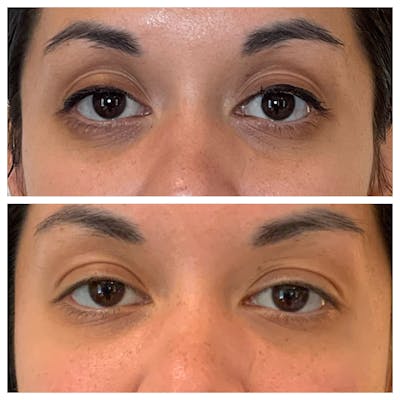 Tear Troughs Before & After Gallery - Patient 111321 - Image 1