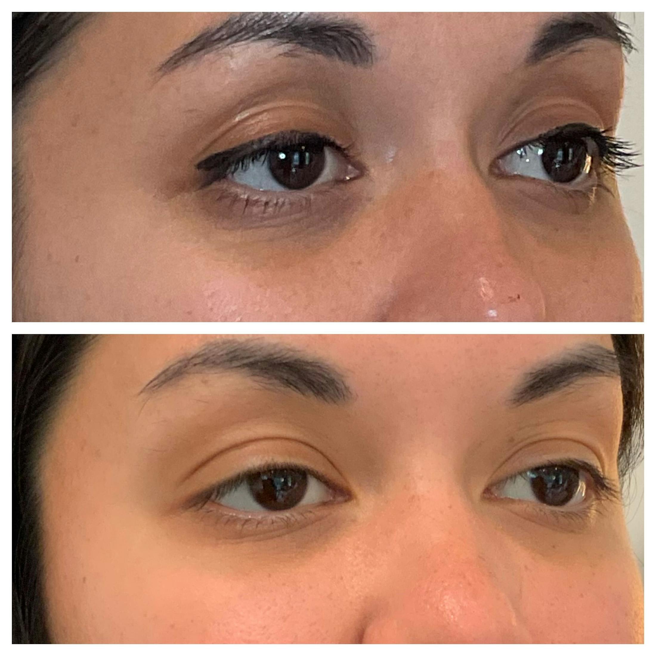 Tear Troughs Before & After Gallery - Patient 111321 - Image 2