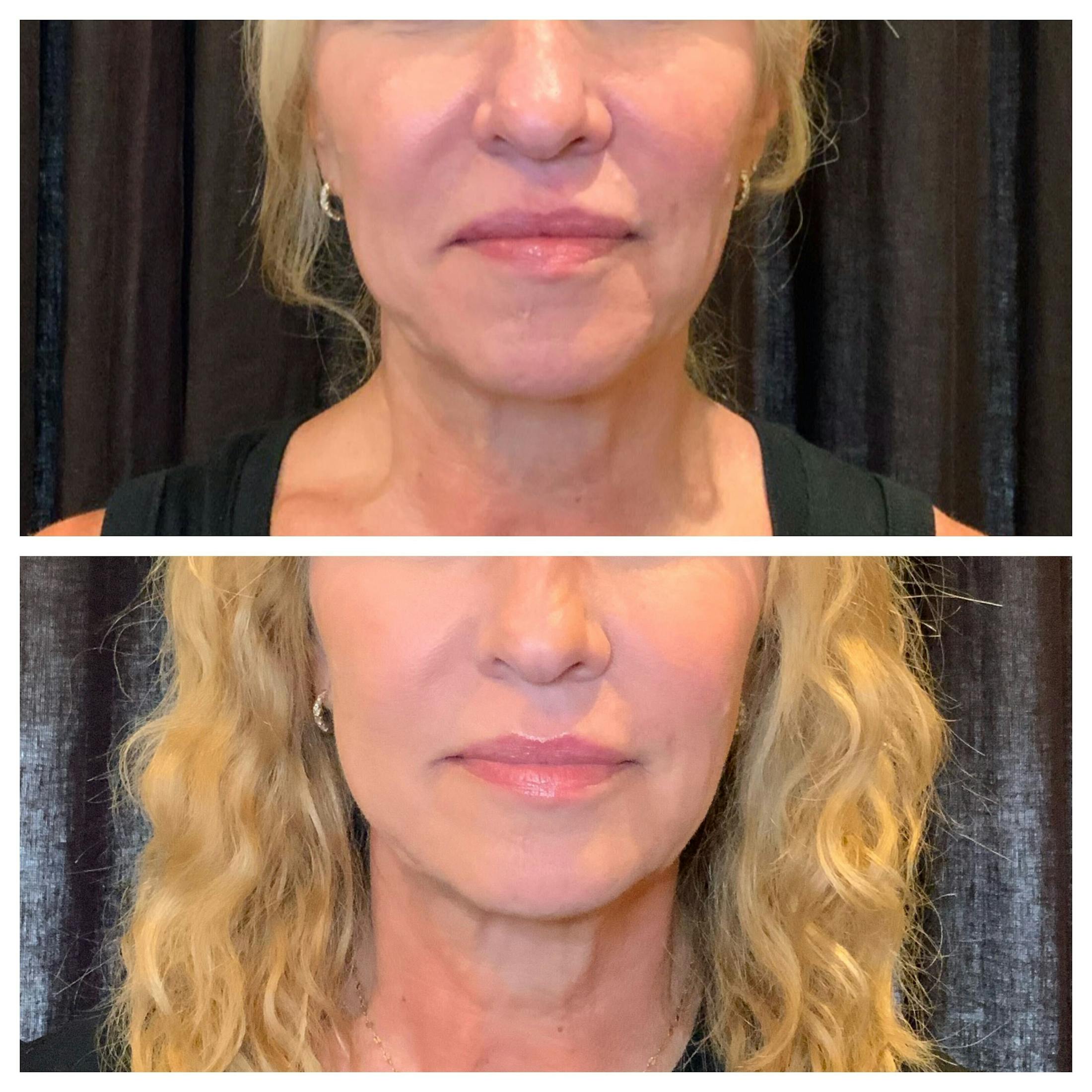 Ultherapy Before & After Gallery - Patient 762426 - Image 4