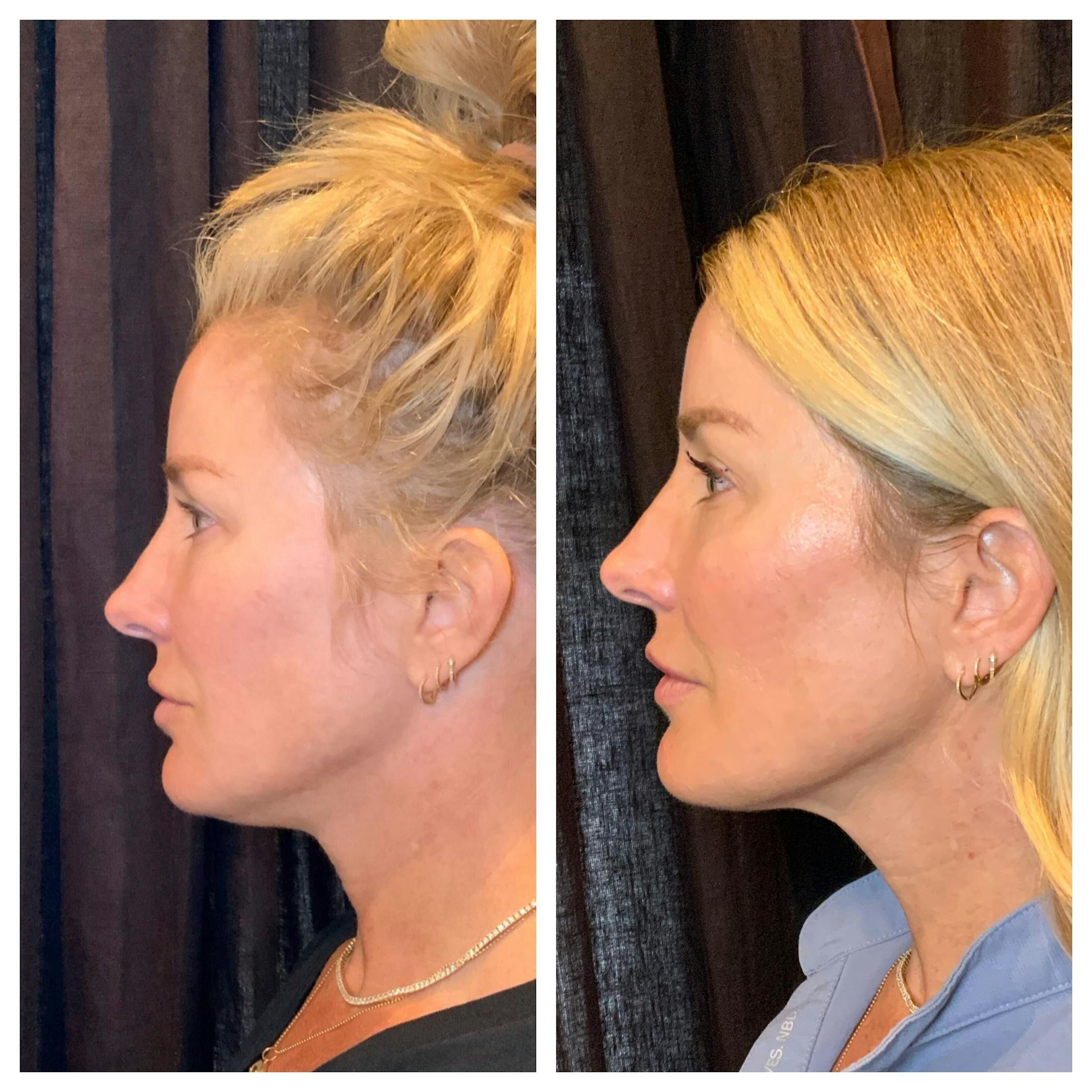 Ultherapy Before & After Gallery - Patient 762426 - Image 3