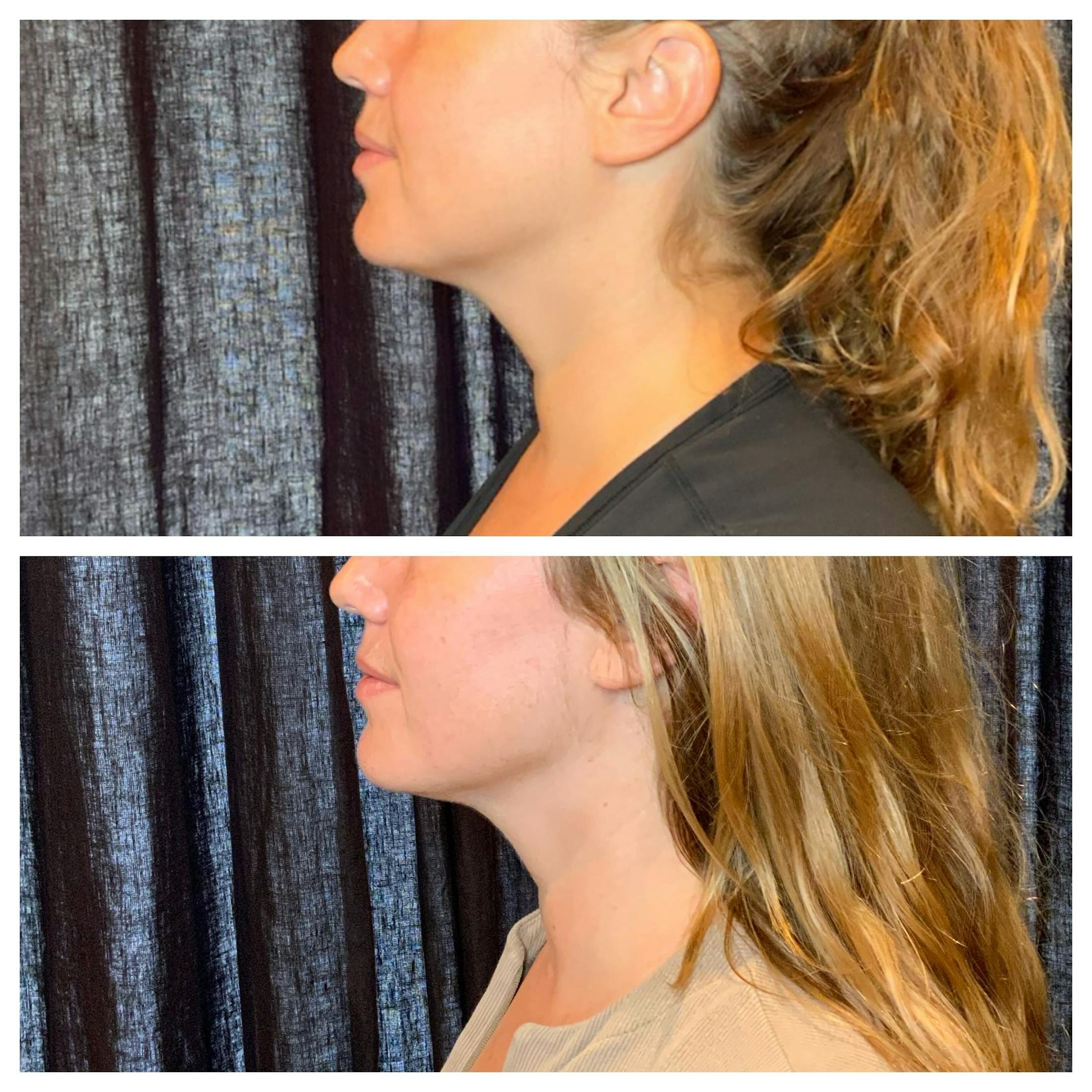 Ultherapy Before & After Gallery - Patient 762426 - Image 6